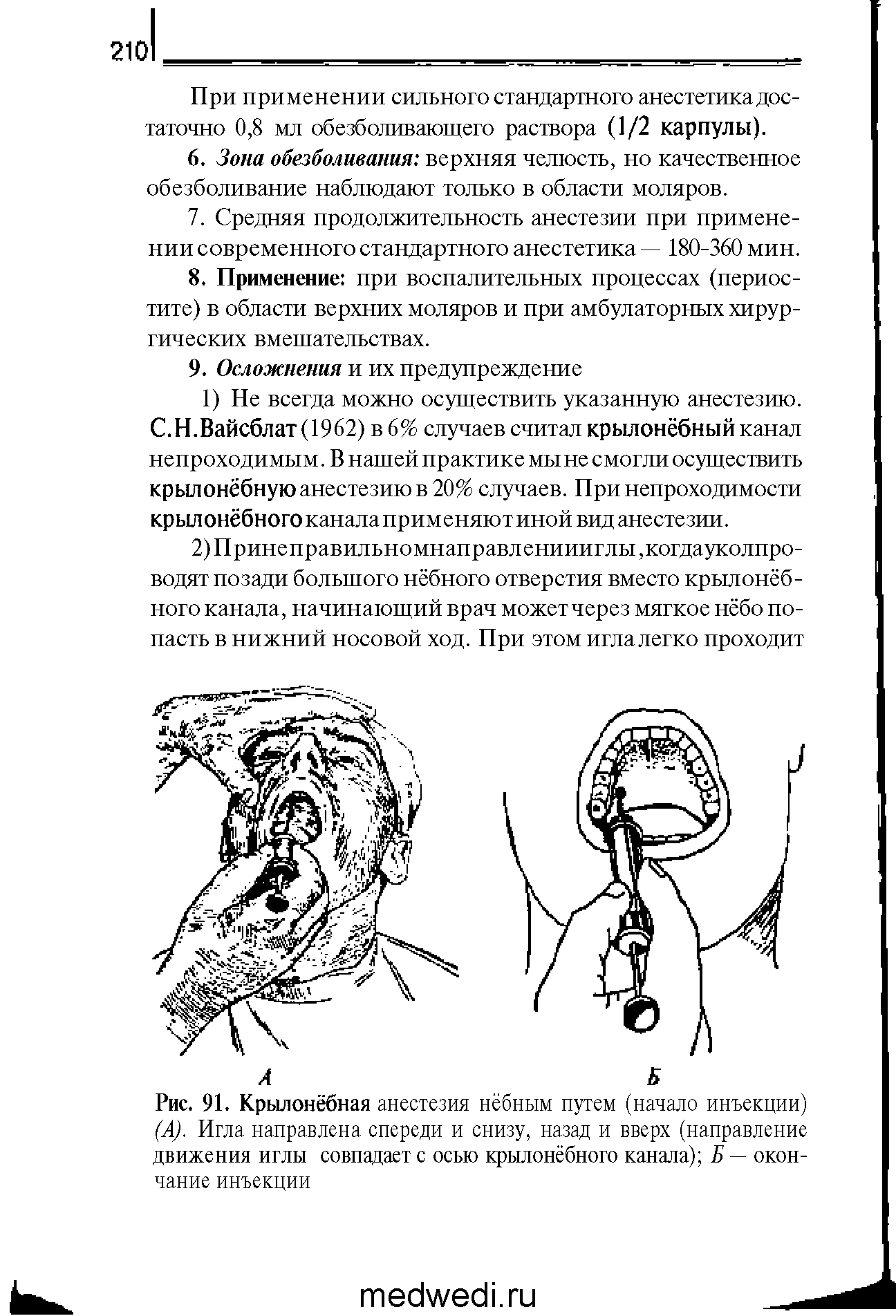 Рис. 91. Крылонёбная анестезия нёбным путем (начало инъекции) (А). Игла направлена спереди и снизу, назад и вверх (направление движения иглы совпадает с осью крылонёбного канала) Б — окончание инъекции...