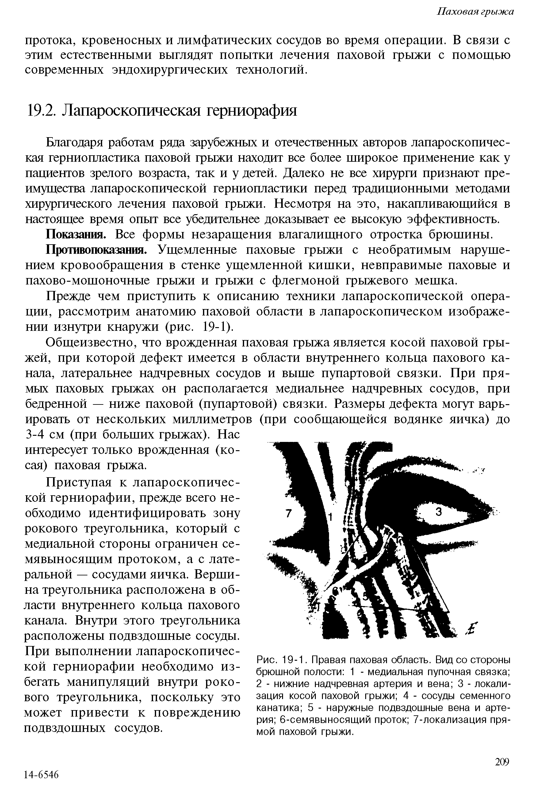 Рис. 19-1. Правая паховая область. Вид со стороны брюшной полости 1 - медиальная пупочная связка 2 - нижние надчревная артерия и вена 3 - локализация косой паховой грыжи 4 - сосуды семенного канатика 5 - наружные подвздошные вена и артерия 6-семявыносящий проток 7-локализация прямой паховой грыжи.