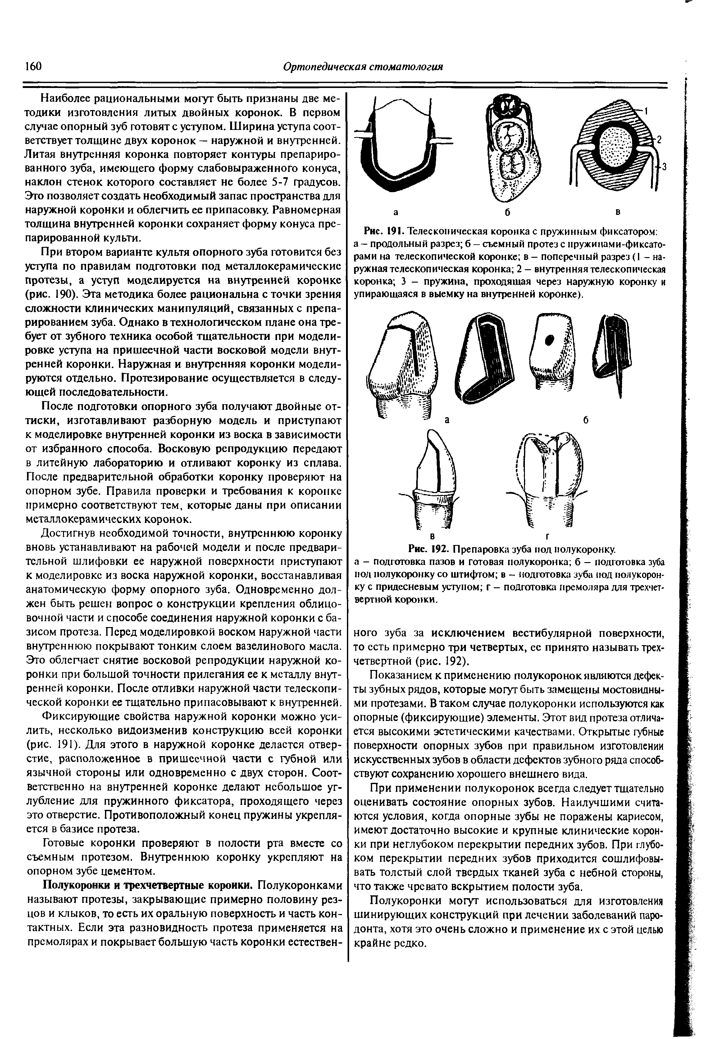 Рис. 191. Телескопическая коровка с пружинным фиксатором а — продольный разрез б — съемный протез с пружинами-фиксаторами на телескопической коронке в - поперечный разрез (1 - наружная телескопическая коронка 2 — внутренняя телескопическая коронка 3 - пружина, проходящая через наружную коронку и упирающаяся в выемку на внутренней коронке).