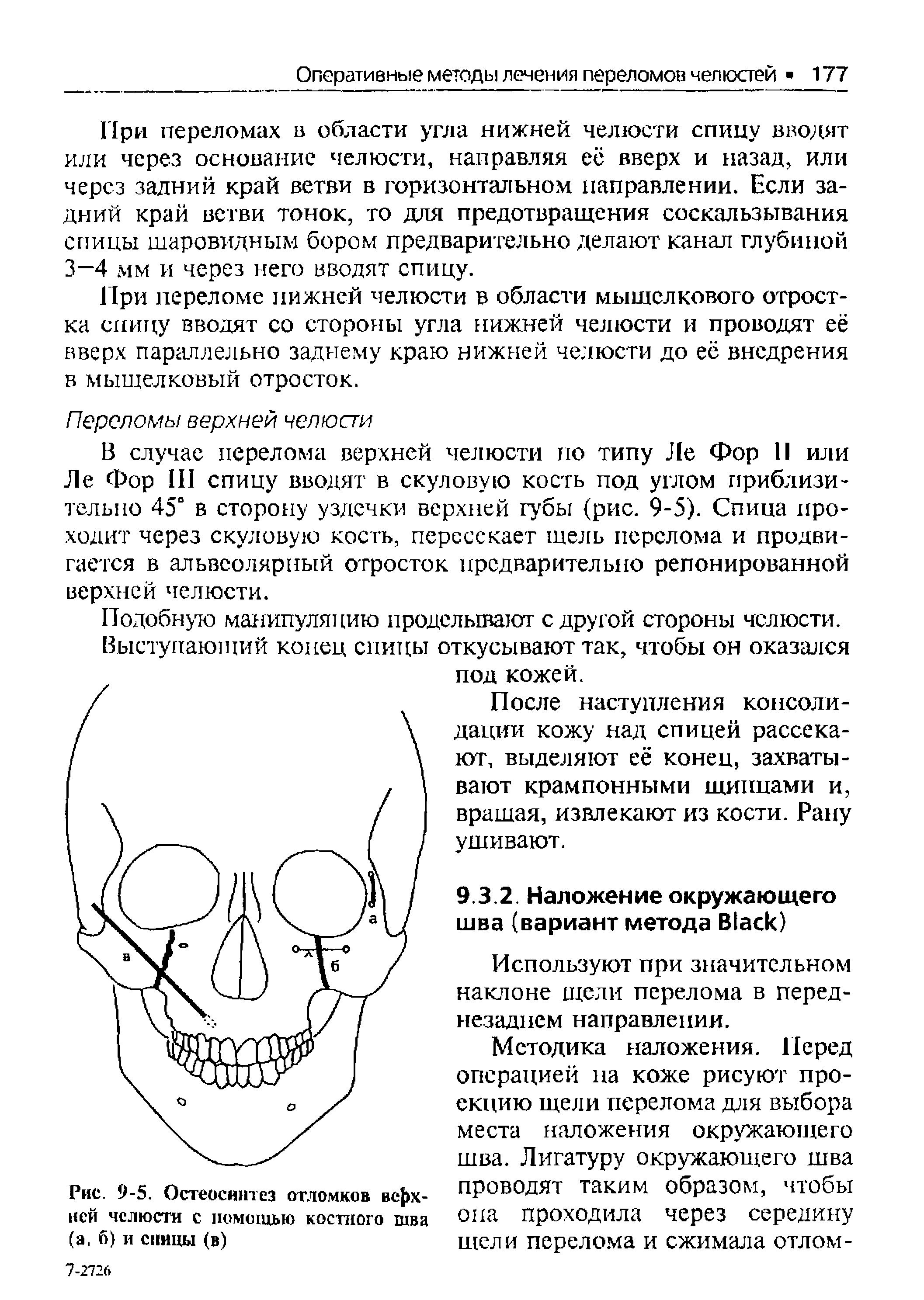 Рис. 9-5. Остеосинтез отломков верхней челюсти с помощью костного шва (а. 6) и спицы (в)...