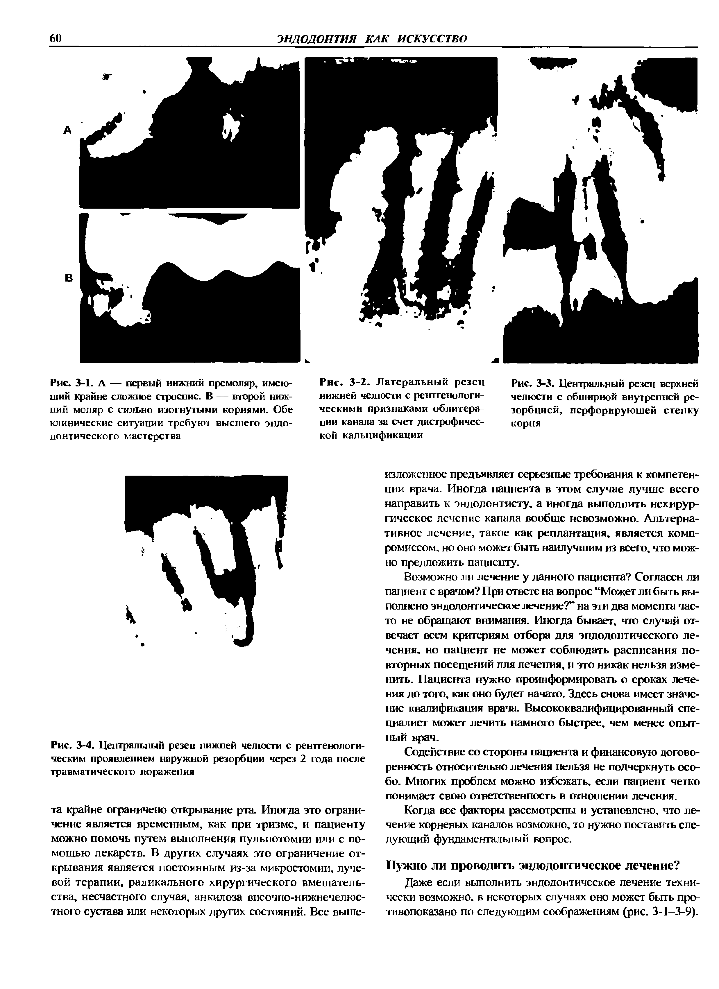 Рис. 3-3. Центральный резец верхней челюсти с обширной внутренней резорбцией, перфорирующей стенку корня...