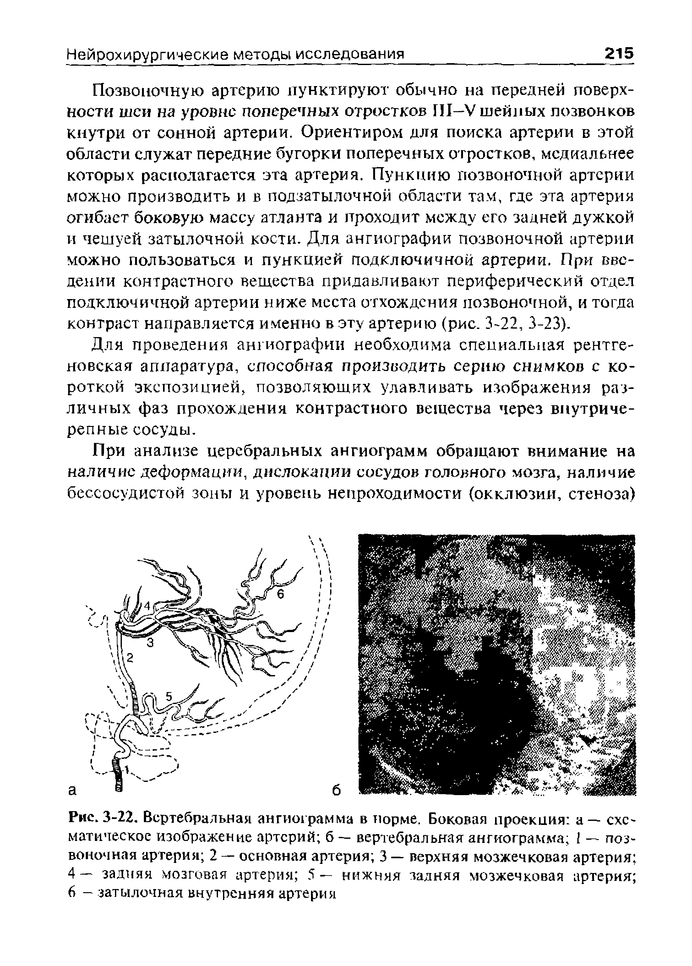 Рис. 3-22, Вертебральная ангиограмма в норме. Боковая проекция а — схематическое изображение артерий б — вертебральная ангиограмма I — позвоночная артерия 2 — основная артерия 3 — верхняя мозжечковая артерия 4— задняя мозговая артерия 5— нижняя задняя мозжечковая артерия 6 —. затылочная внутренняя артерия...