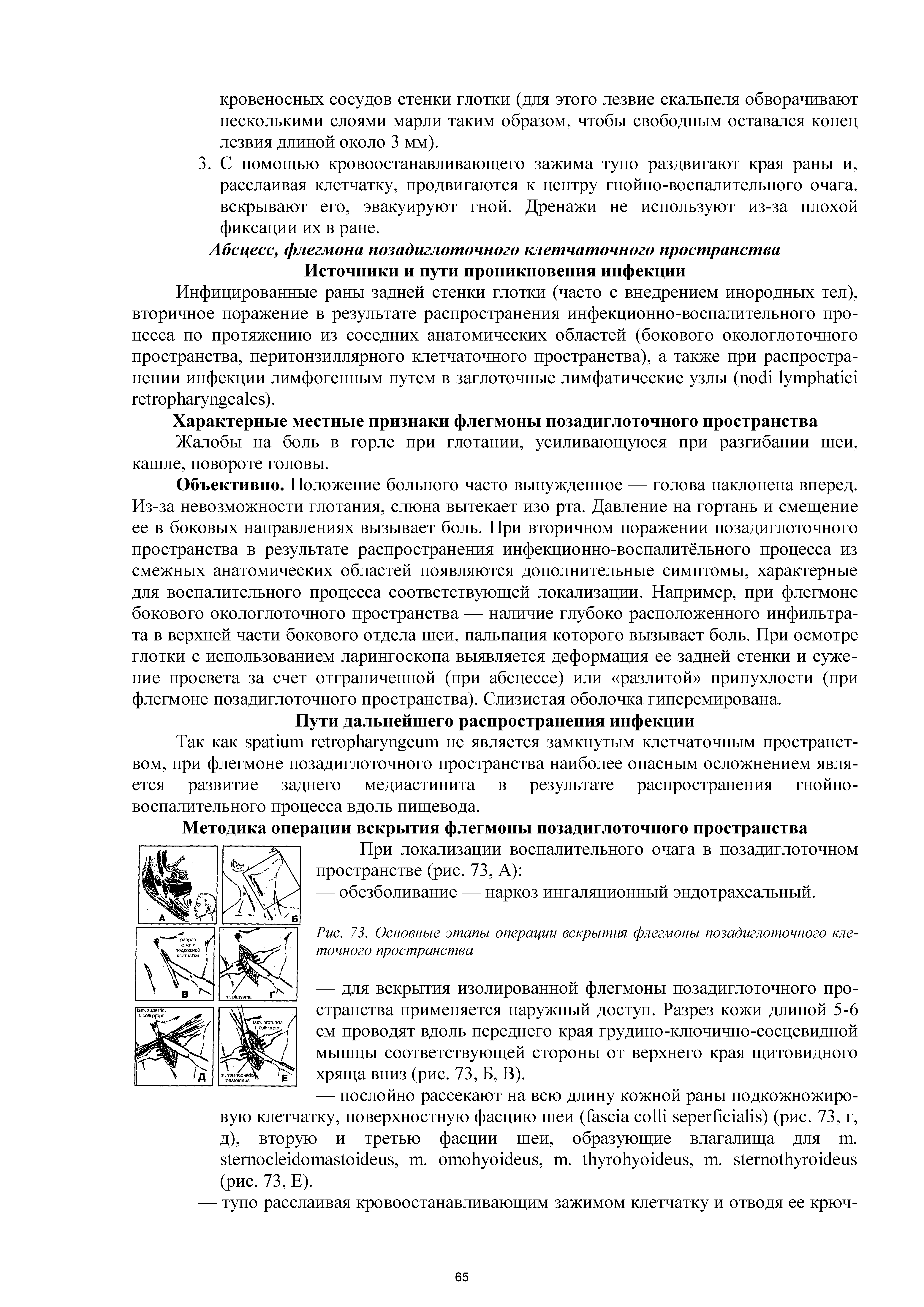 Рис. 73. Основные этапы операции вскрытия флегмоны позадиглоточного клеточного пространства...