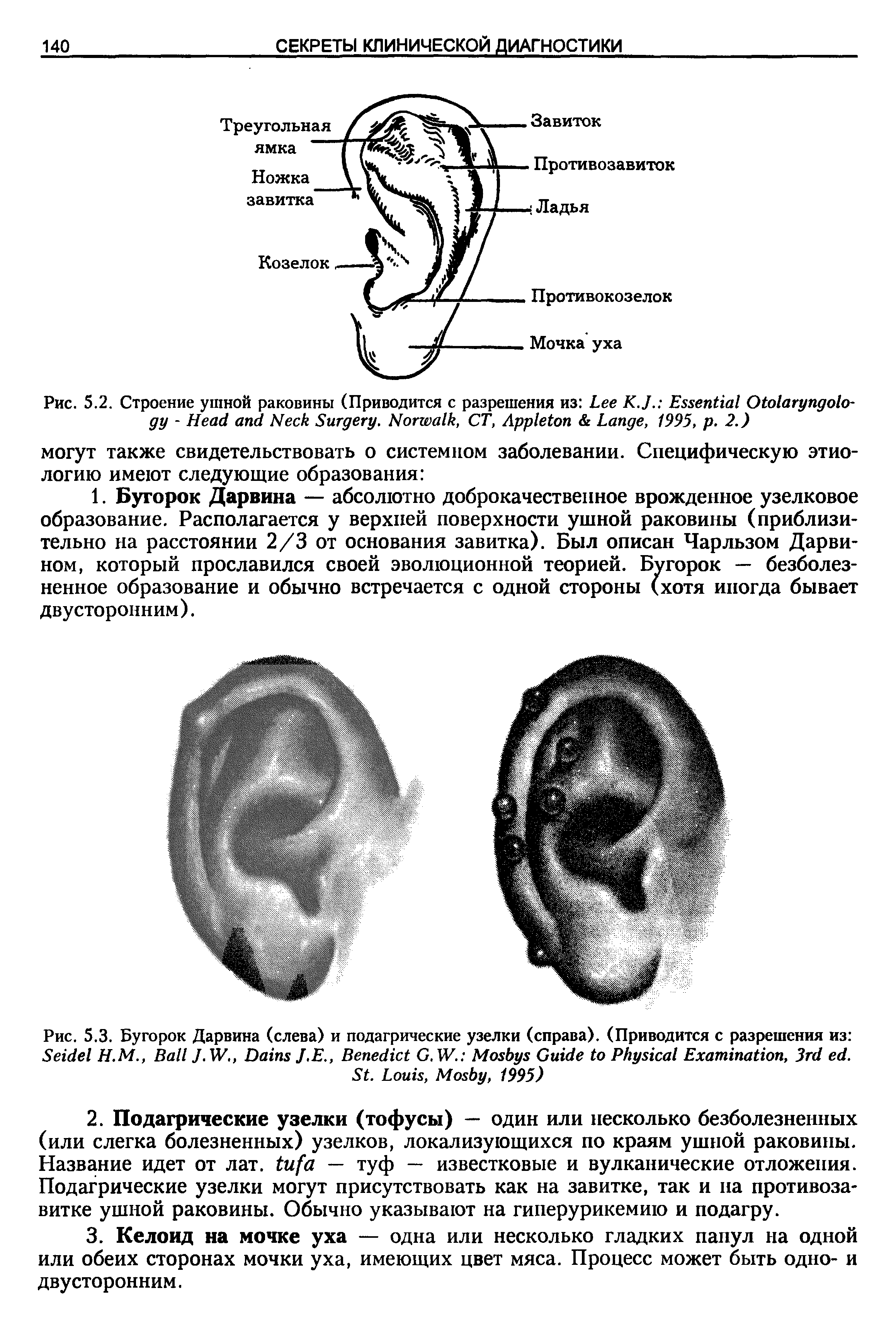Рис. 5.3. Бугорок Дарвина (слева) и подагрические узелки (справа). (Приводится с разрешения из S Н.М., B J.W., D J.E., B G.W. M G P E , 3 . S . L , M , 1995)...