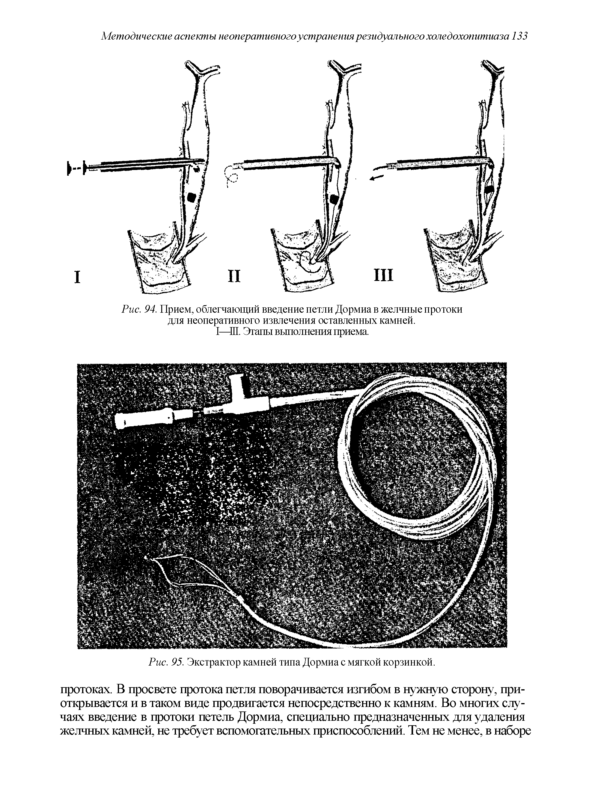 Рис. 94. Прием, облегчающий введение петли Дормиа в желчные протоки для неоперативного извлечения оставленных камней.