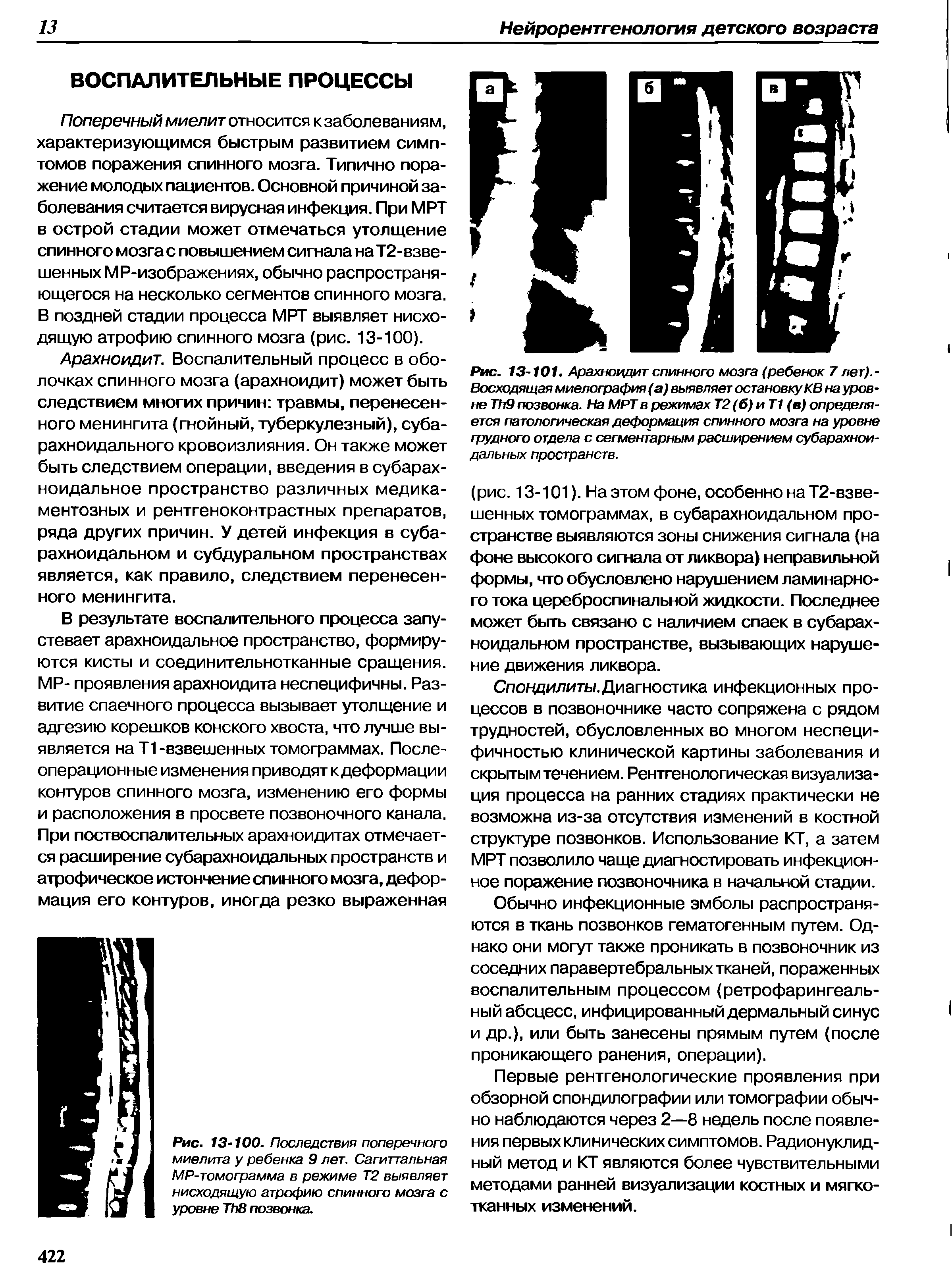 Рис. 13-101. Арахноидит спинного мозга (ребенок 7лет).-Восходящая миелография (а) выявляет остановку КВ на уровне T 9 позвонка. На МРТ в режимах Т2(б)иТ1 (в) определяется патологическая деформация спинного мозга на уровне грудного отдела с сегментарным расширением субарахноидальных пространств.