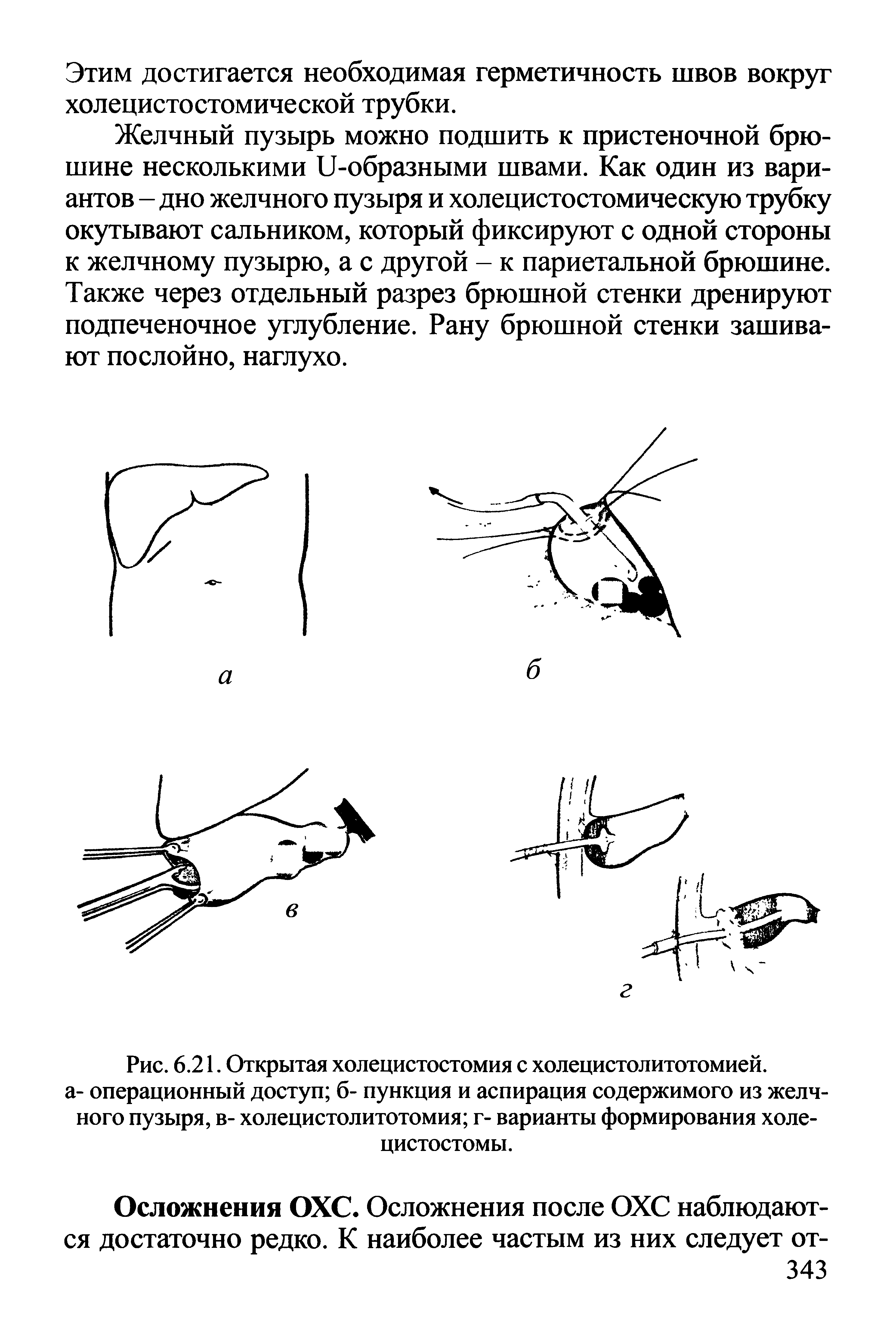 Рис. 6.21. Открытая холецистостомия с холецистолитотомией. а- операционный доступ б- пункция и аспирация содержимого из желчного пузыря, в- холецистолитотомия г- варианты формирования холе-цистостомы.