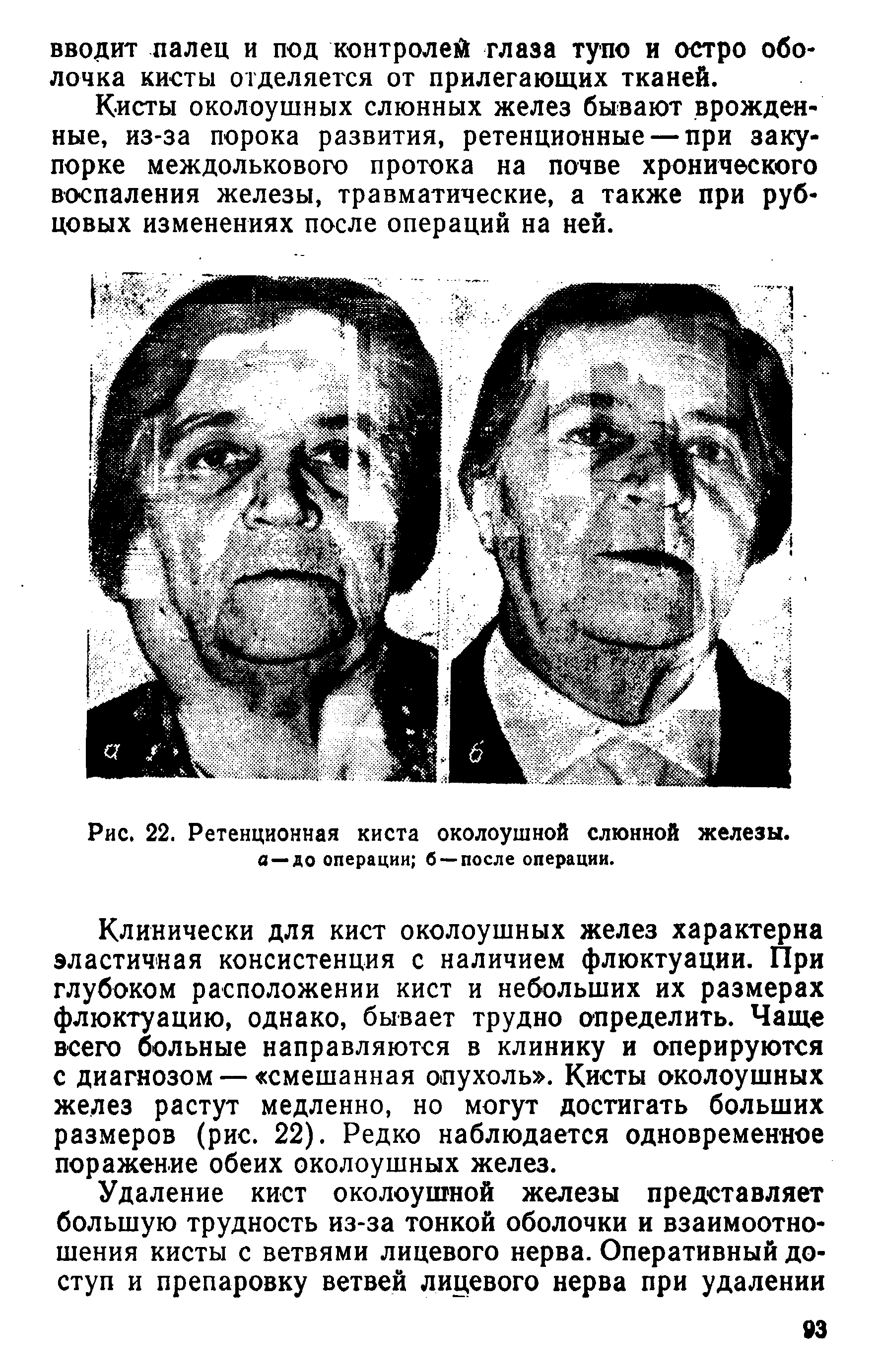 Рис. 22. Ретенционная киста околоушной слюнной железы, а —до операции б —после операции.