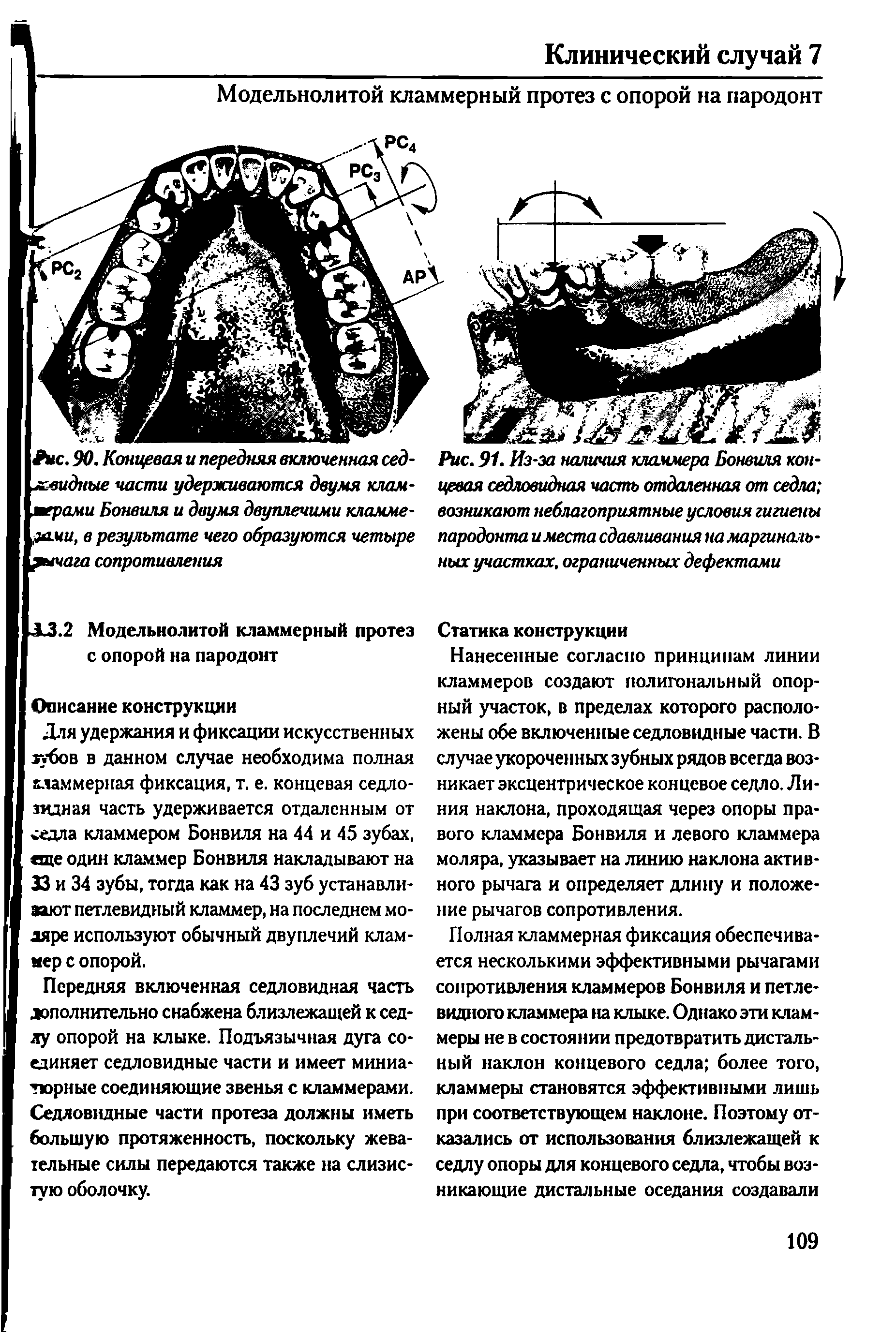 Рис. 91. Из-за наличия кламмера Бонвиля концевая седловидная часть отдаленная от седла возникают неблагоприятные условия гигиены пародонтаи места сдавливания на маргинальных участках, ограниченных дефектами...