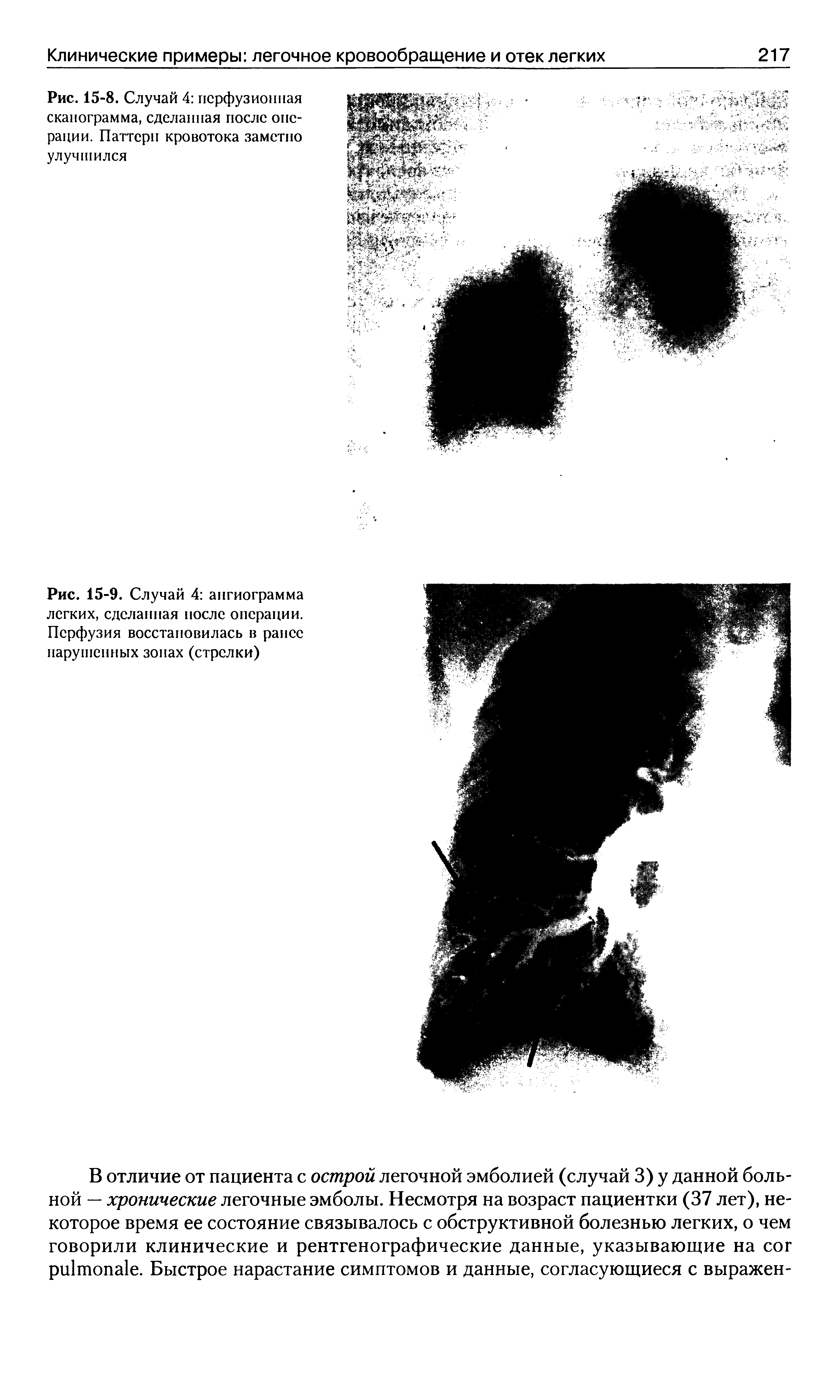 Рис. 15-9. Случай 4 ангиограмма легких, сделанная после операции. Перфузия восстановилась в ранее нарушенных зонах (стрелки)...