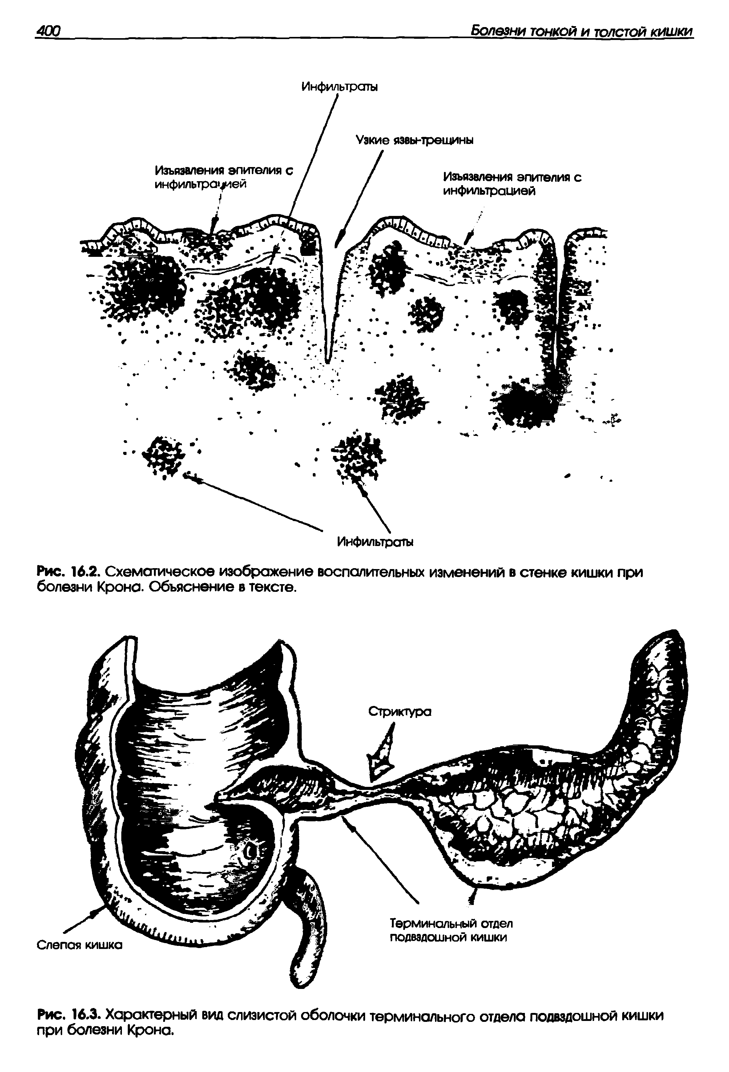 Рис. 16.2. Схематическое изображение воспалительных изменений в стенке кишки при болезни Крона. Объяснение в тексте.