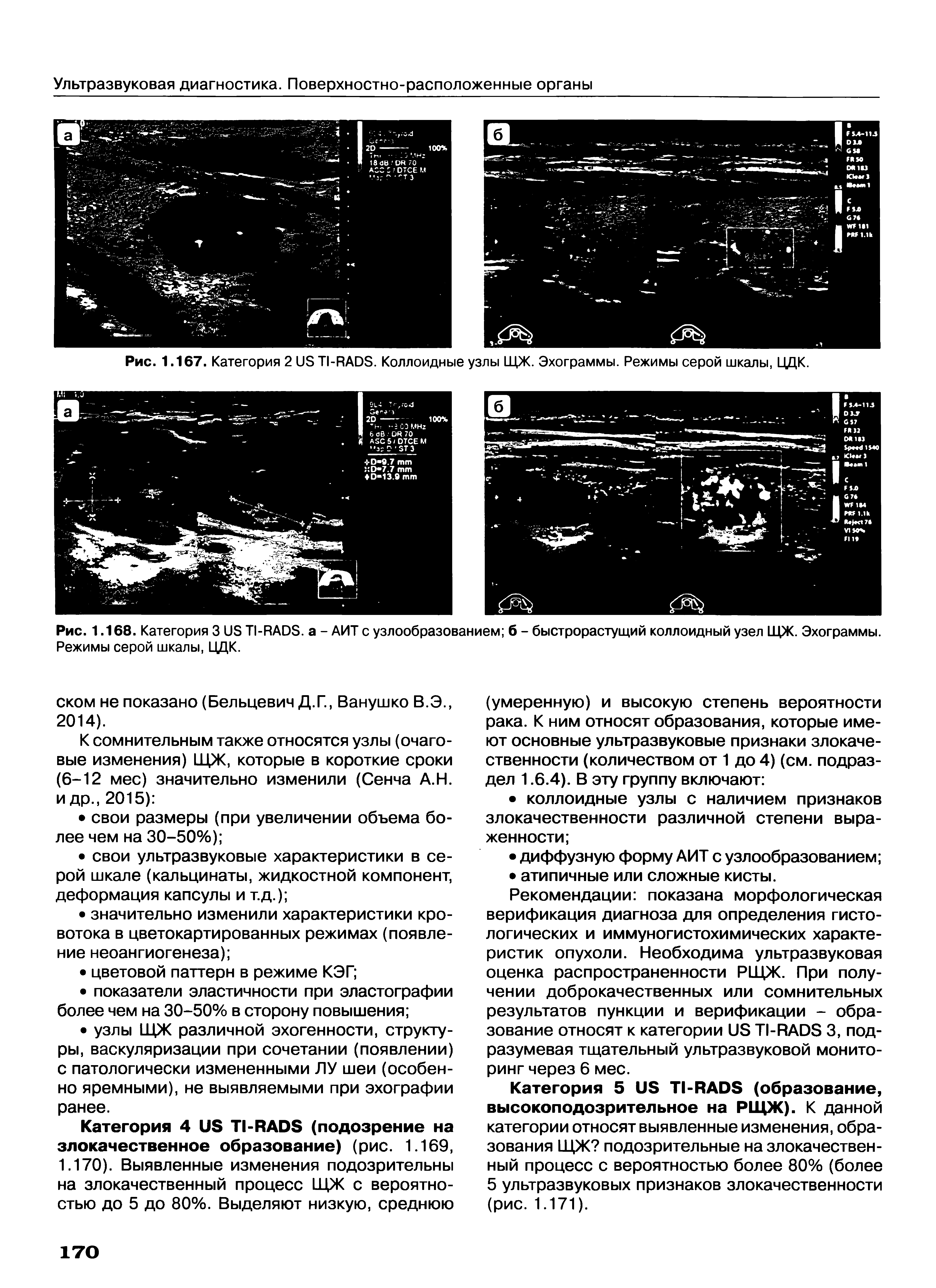 Рис. 1.167. Категория 2ЦЭ Т1-РАОЭ. Коллоидные узлы ЩЖ. Эхограммы. Режимы серой шкалы, ЦДК.