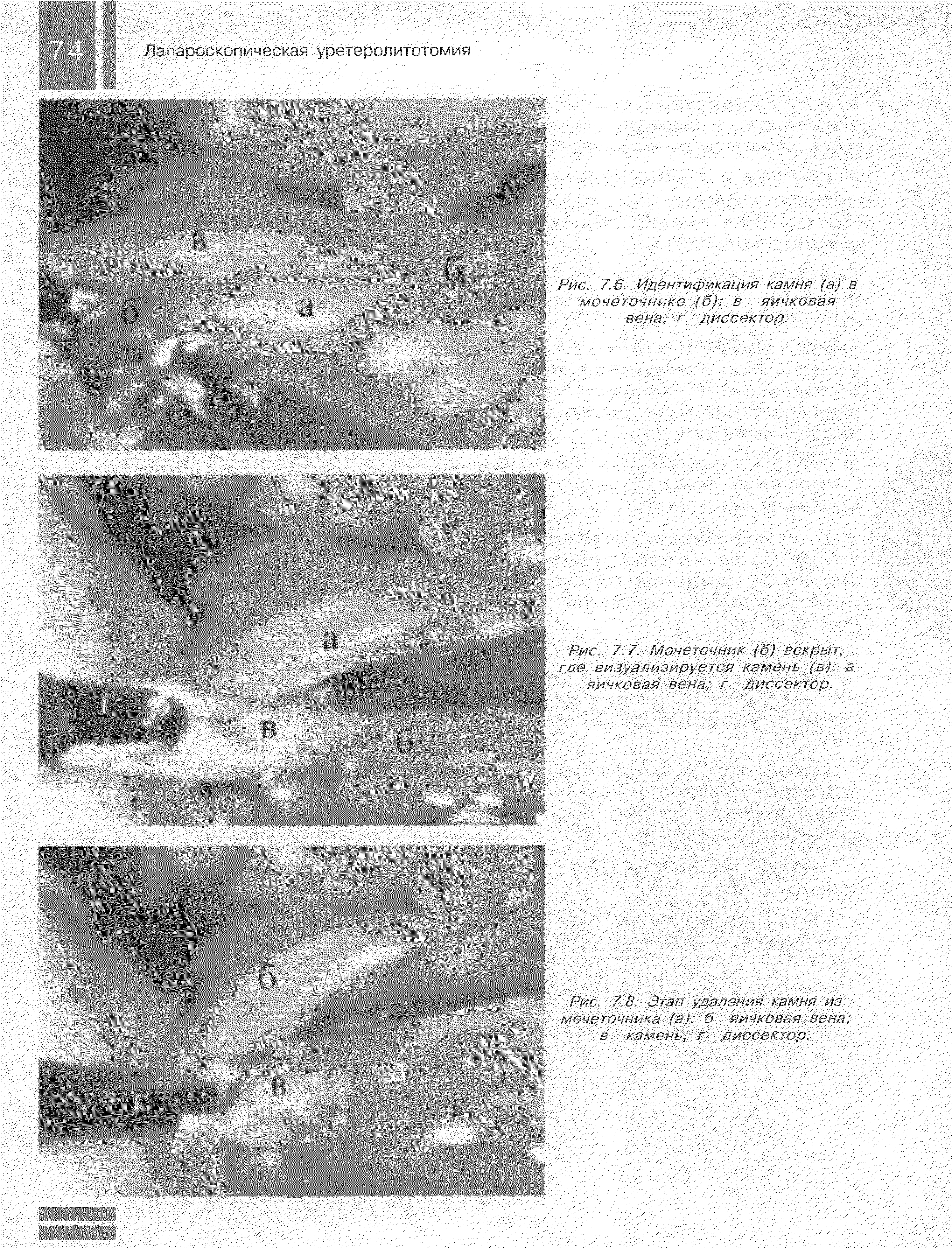 Рис. 7.6. Идентификация камня (а) в мочеточнике (б) в яичковая вена, г диссектор.