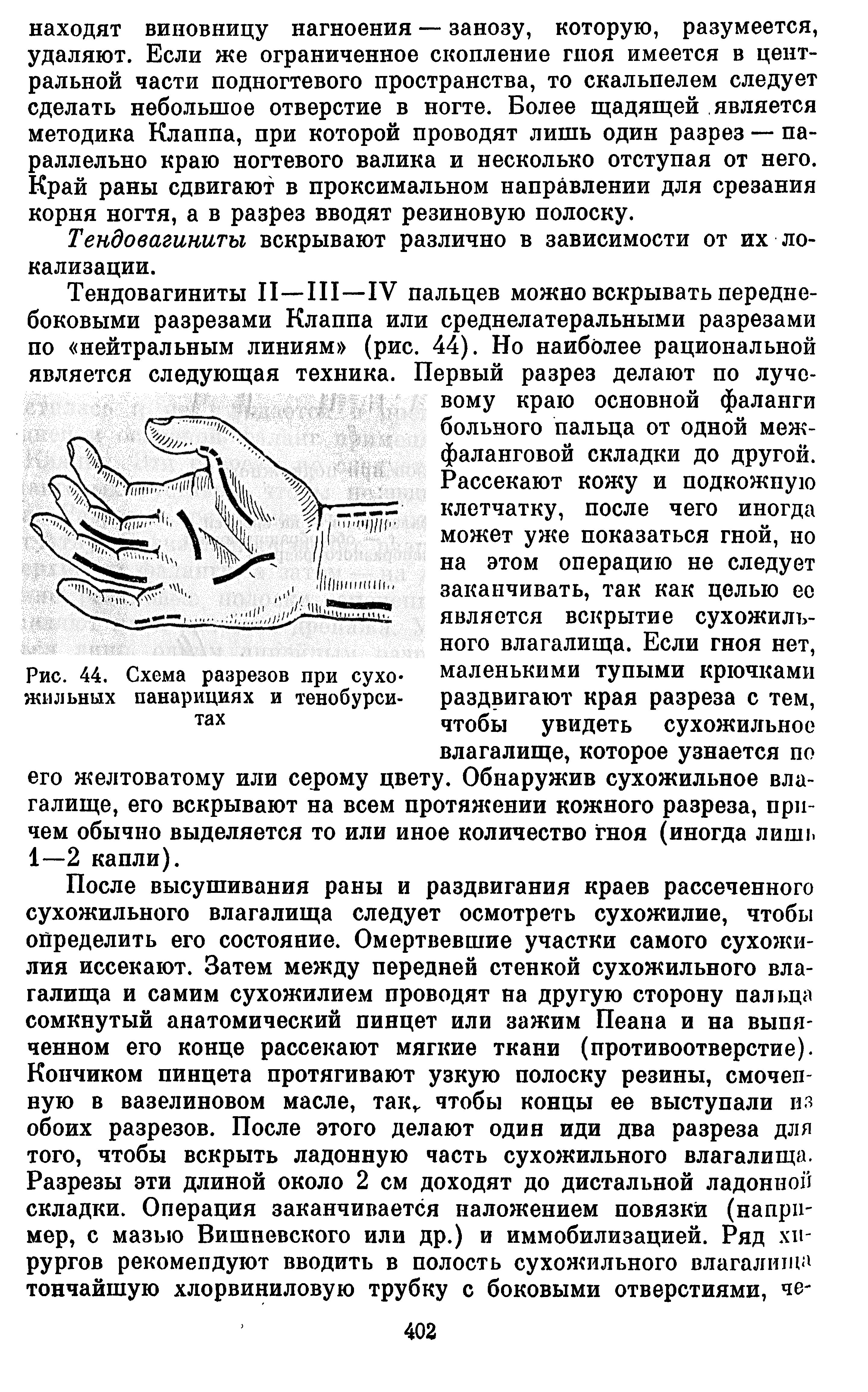 Рис. 44. Схема разрезов при сухо жильных панарициях и тенобурси-тах...