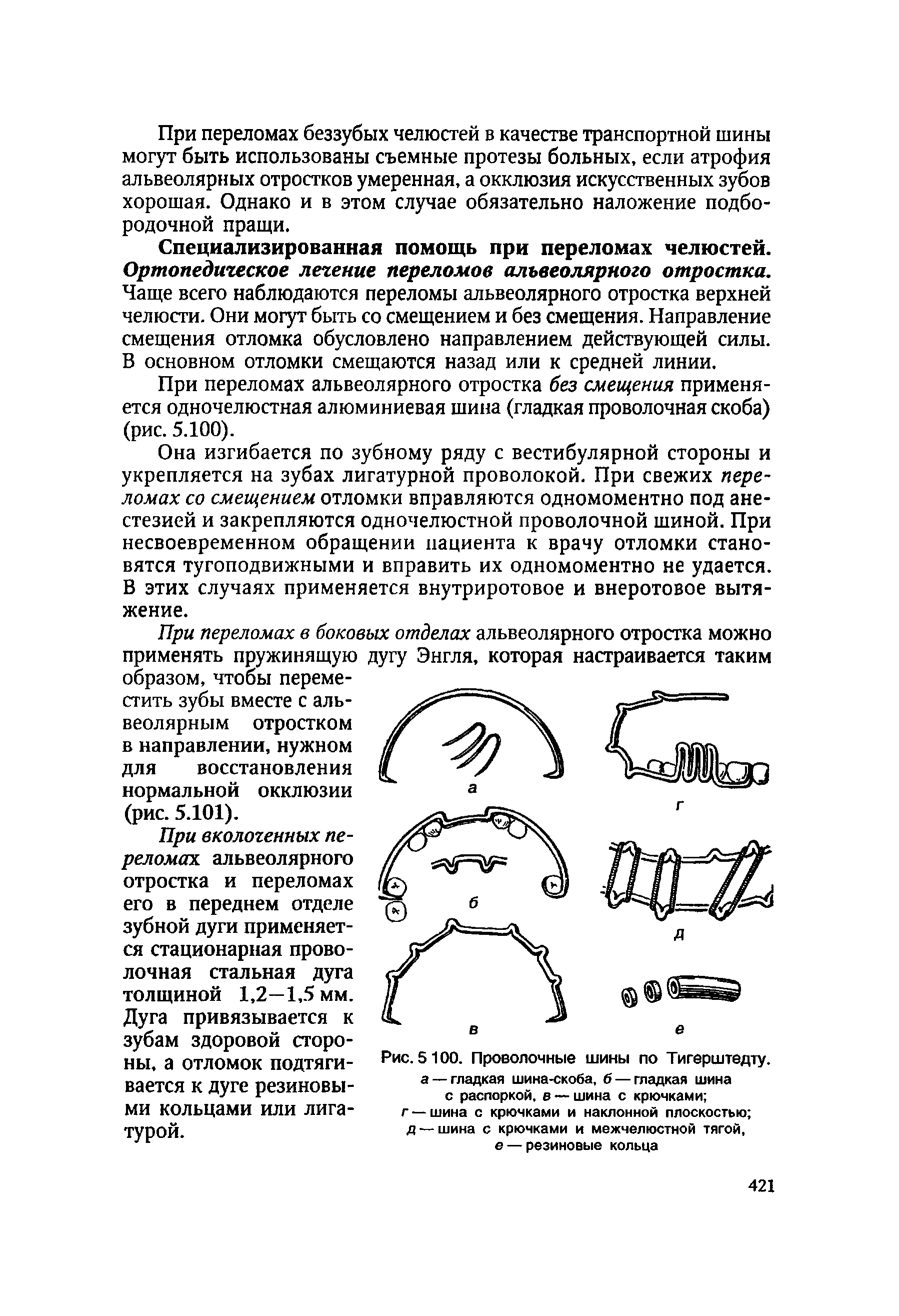 Рис. 5100. Проволочные шины по Тигерштедту. а— гладкая шина-скоба, б — гладкая шина с распоркой, в — шина с крючками ...