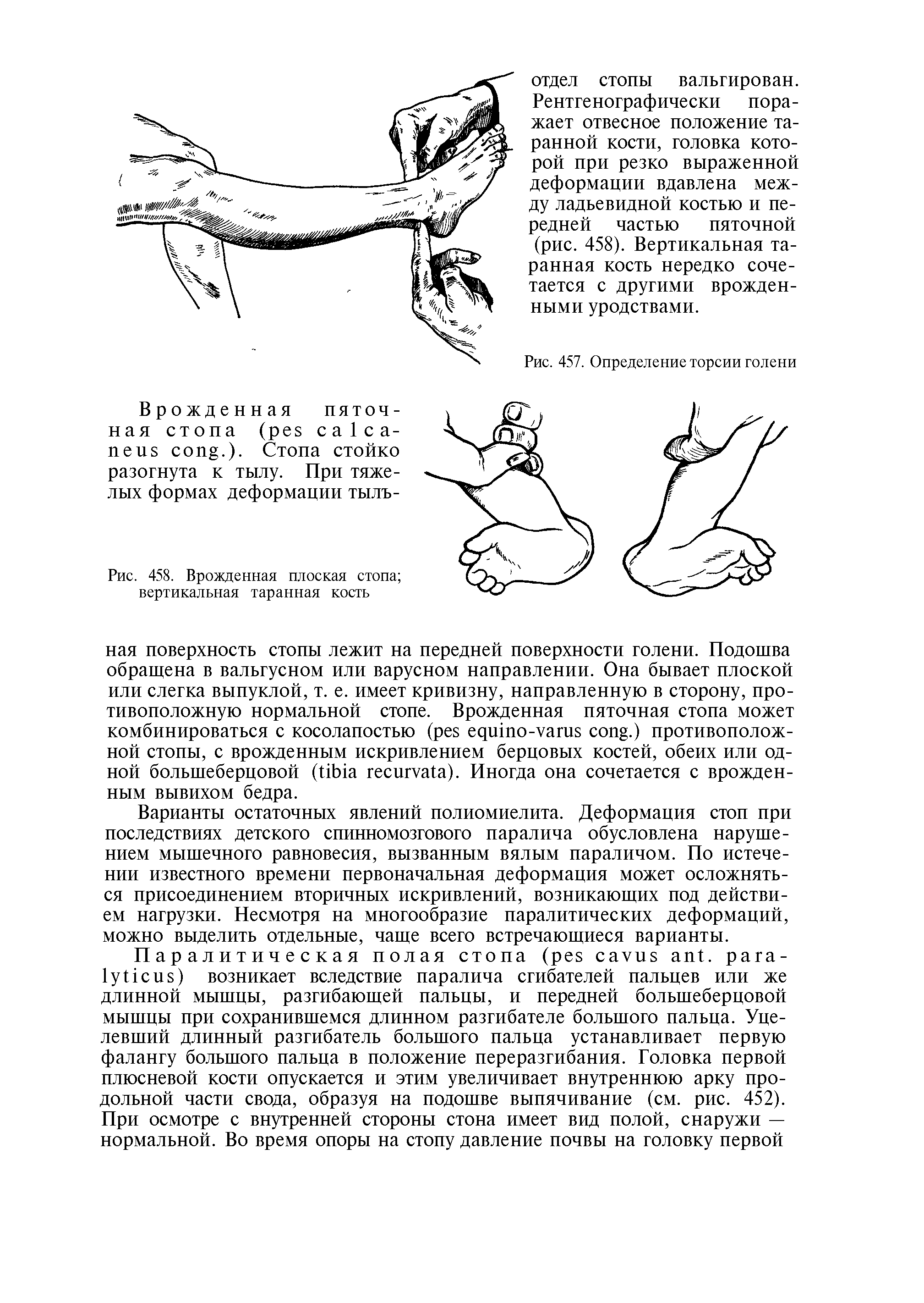 Рис. 458. Врожденная плоская стопа вертикальная таранная кость...