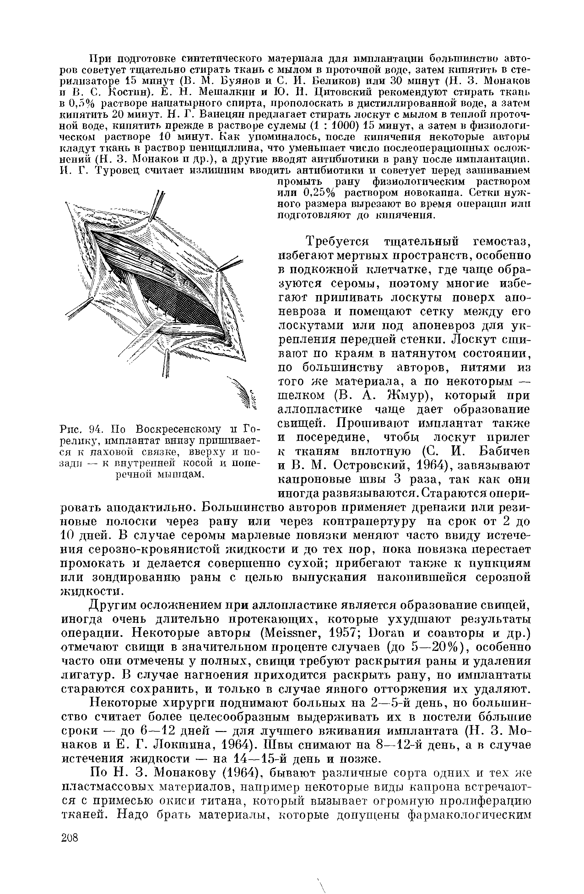 Рис. 94. По Воскресенскому п Горелику, имплантат внизу пришивается к паховой связке, вверху и позади — к внутренней косой и поперечной мышцам.