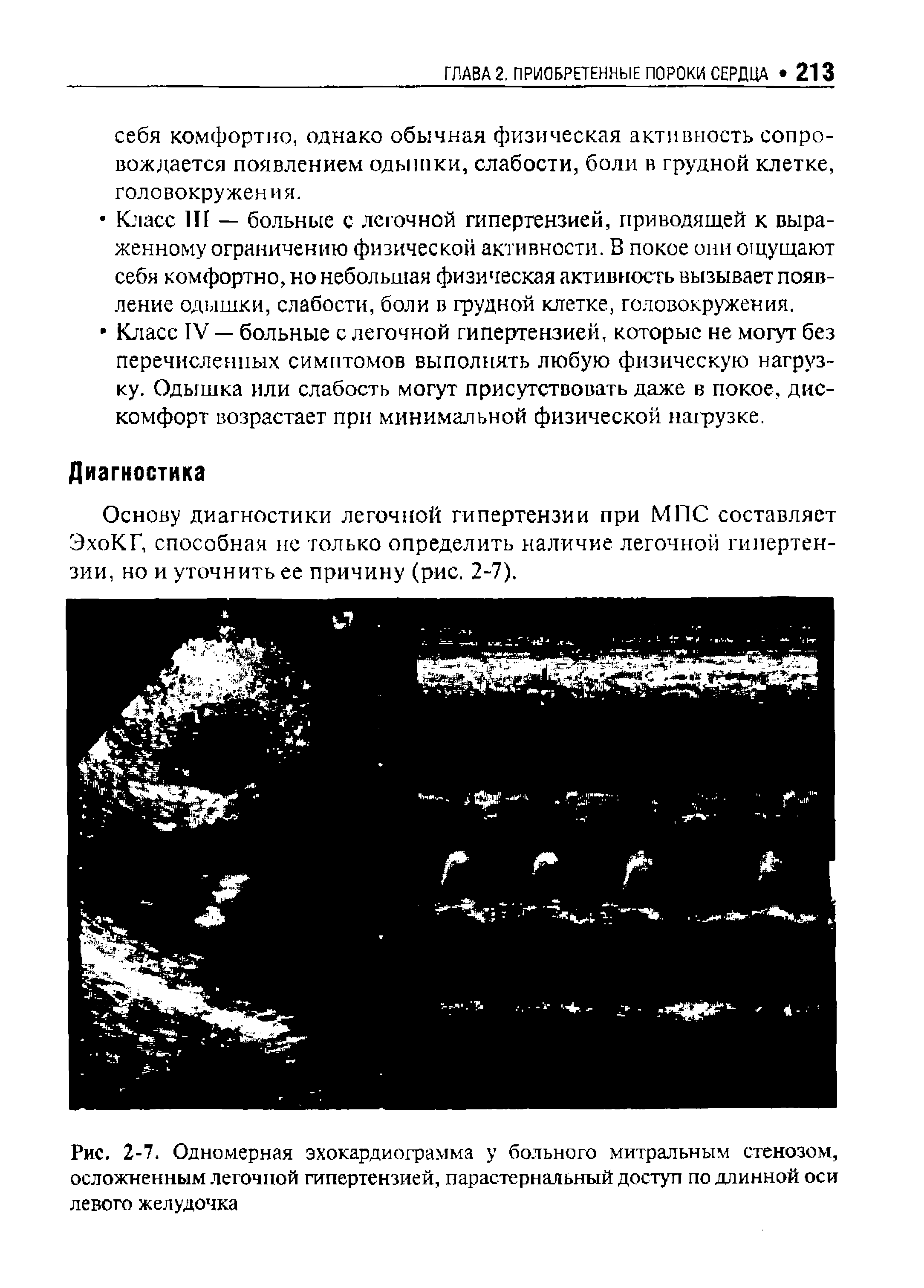 Рис. 2-7. Одномерная эхокардиограмма у больного митральным стенозом, осложненным легочной гипертензией, парастернальный доступ по длинной оси левого желудочка...