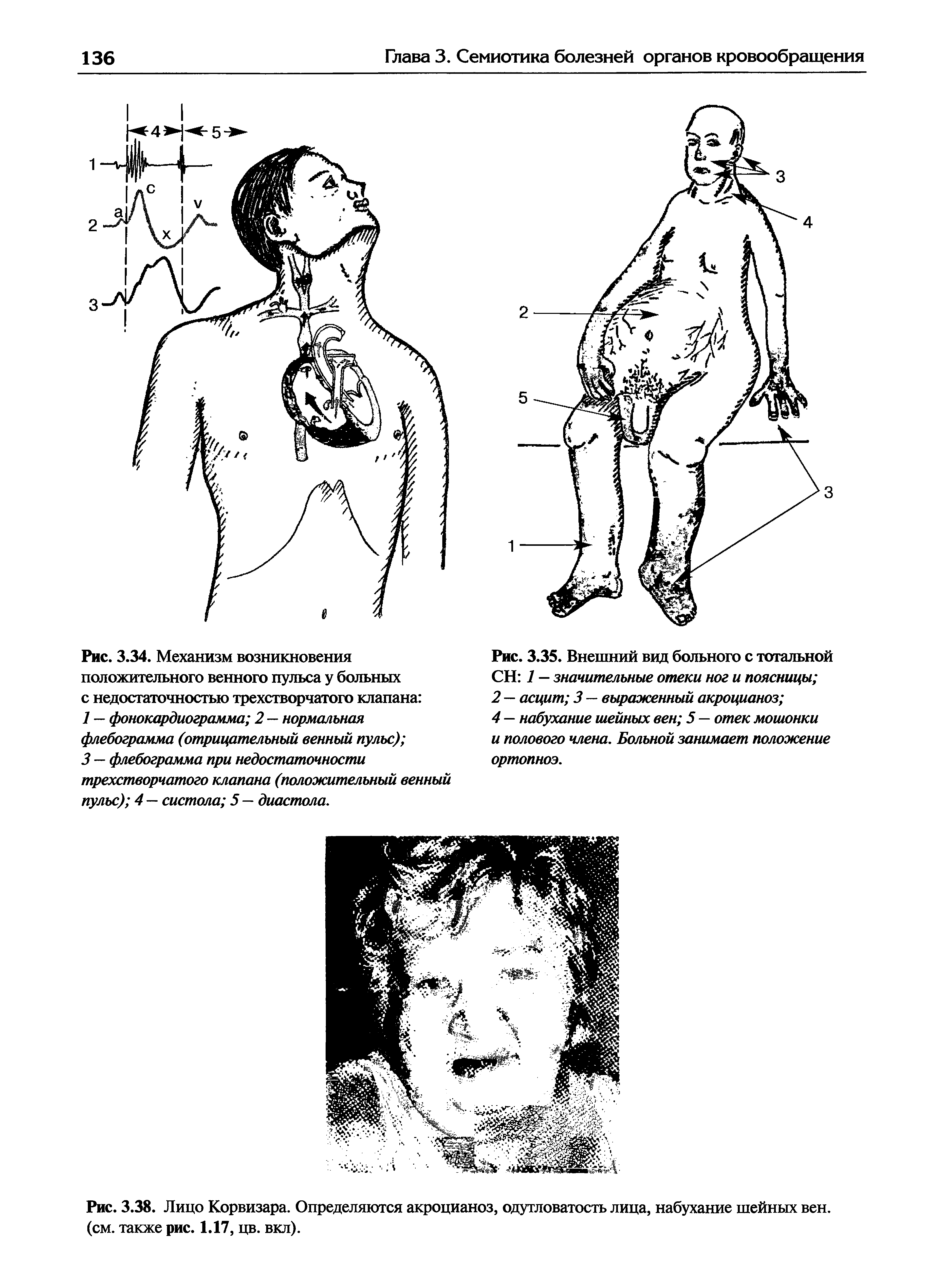 Рис. 3.38. Лицо Корвизара. Определяются акроцианоз, одутловатость лица, набухание шейных вен. (см. также рис. 1.17, цв. вкл).