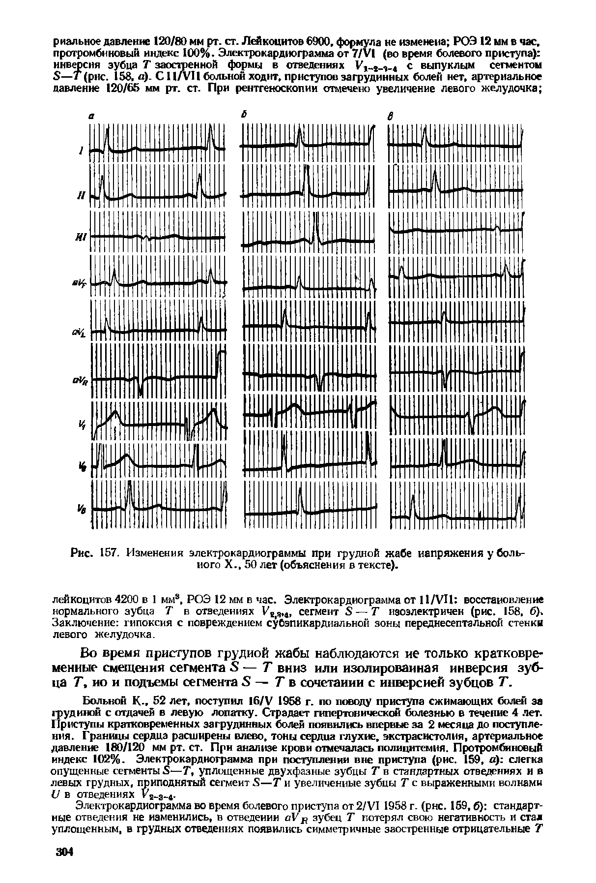 Рис. 157. Изменения электрокардиограммы при грудной жабе напряжения у больного X., 50 лет (объяснения в тексте).