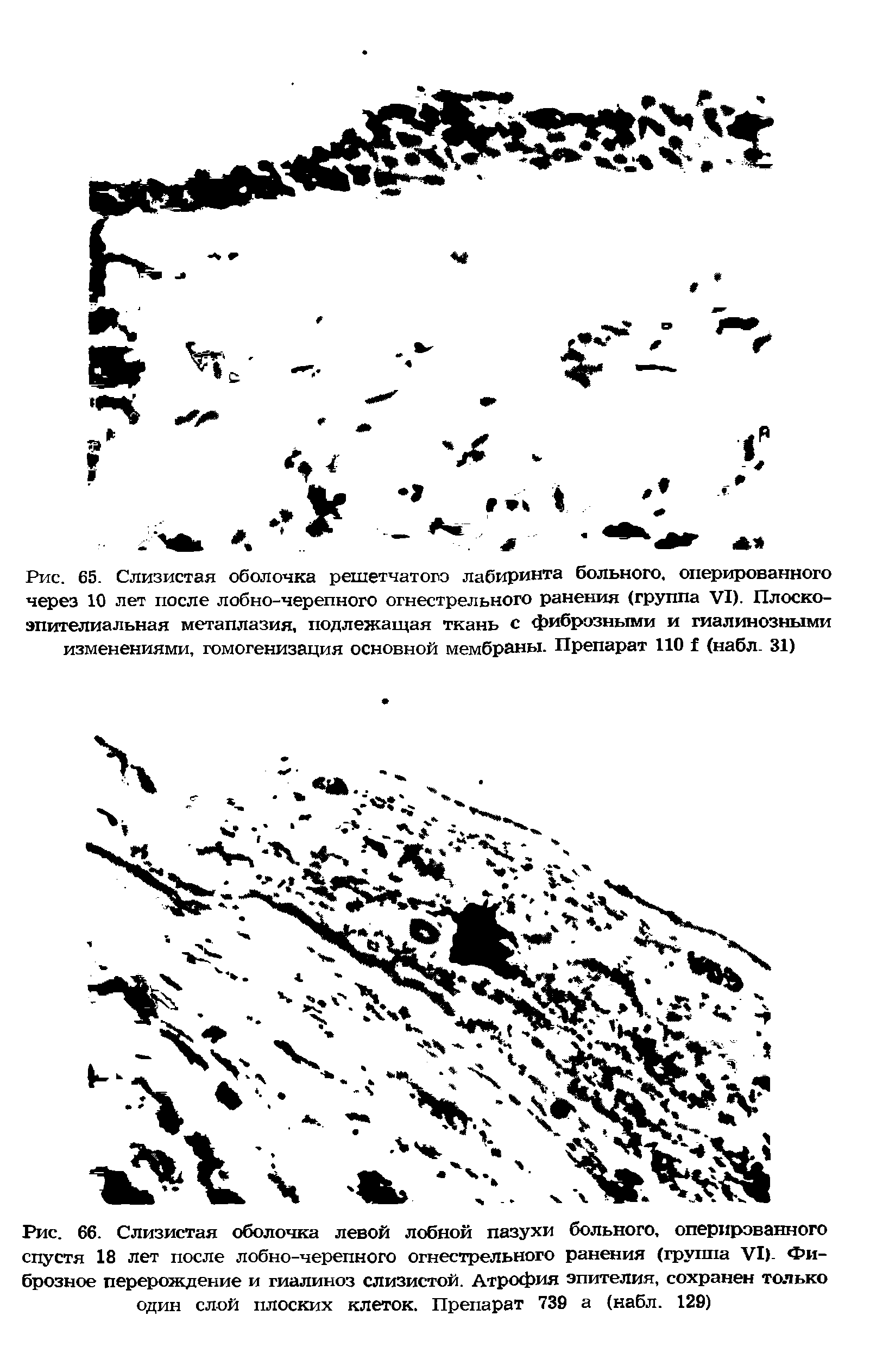 Рис. 66. Слизистая оболочка левой лобной пазухи больного, оперированного спустя 18 лет после лобно-черепного огнестрельного ранения (группа VI). Фиброзное перерождение и гиалиноз слизистой. Атрофия эпителия, сохранен только один слой плоских клеток. Препарат 739 а (набл. 129)...