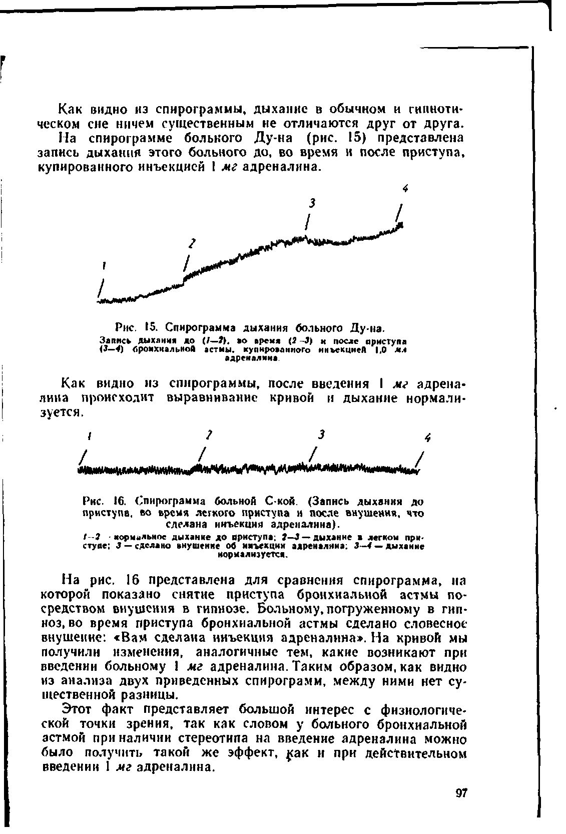 Рис. 15. Спнрограмма дыхания больного Ду-на. Запись дыхания до (/— >. ао время (3 -3) и после приступа (3— 4) бронхиальной астмы, купированного инъекцией 1,0 мл адреналина...