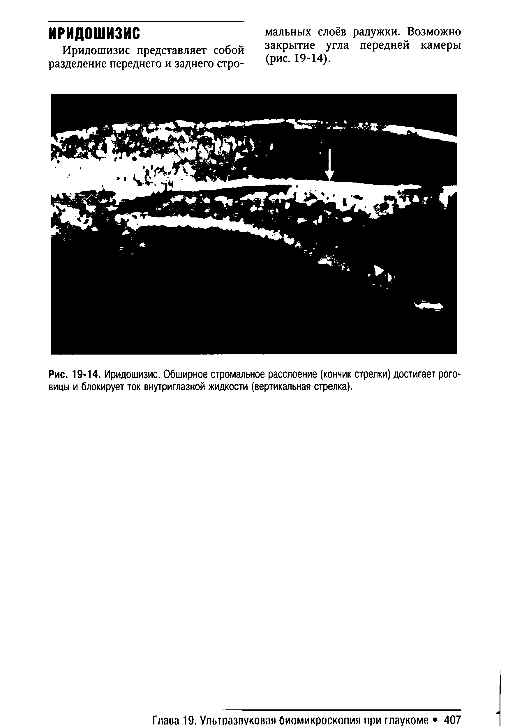 Рис. 19-14. Иридошизис. Обширное стромальное расслоение (кончик стрелки) достигает роговицы и блокирует ток внутриглазной жидкости (вертикальная стрелка).