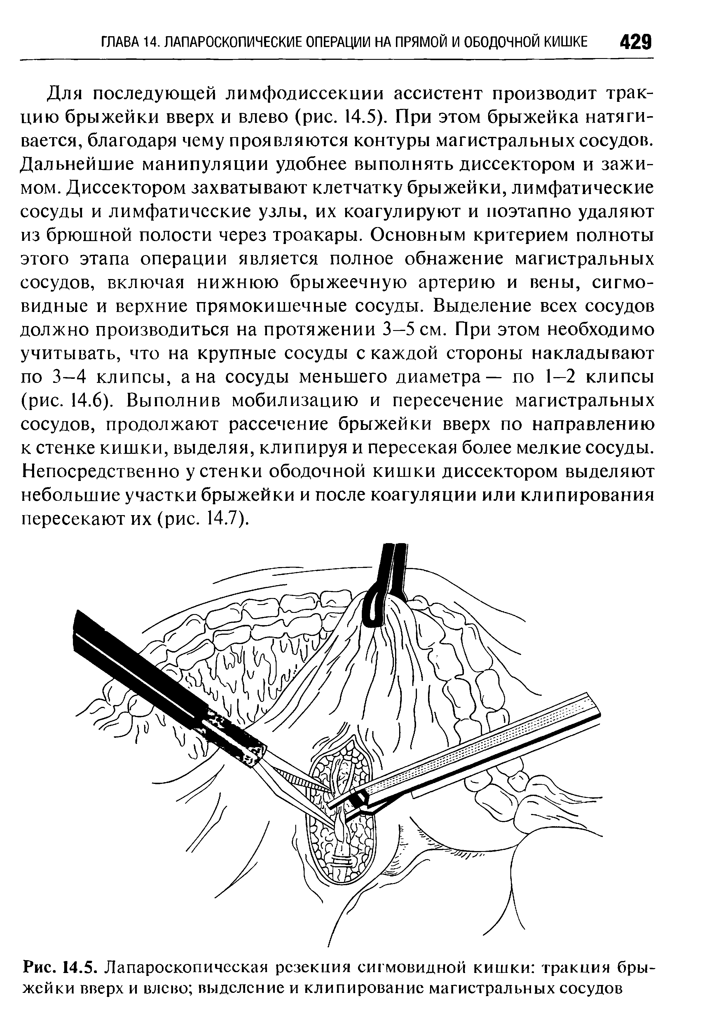 Рис. 14.5. Лапароскопическая резекция сигмовидной кишки тракция брыжейки вверх и влево выделение и клипирование магистральных сосудов...