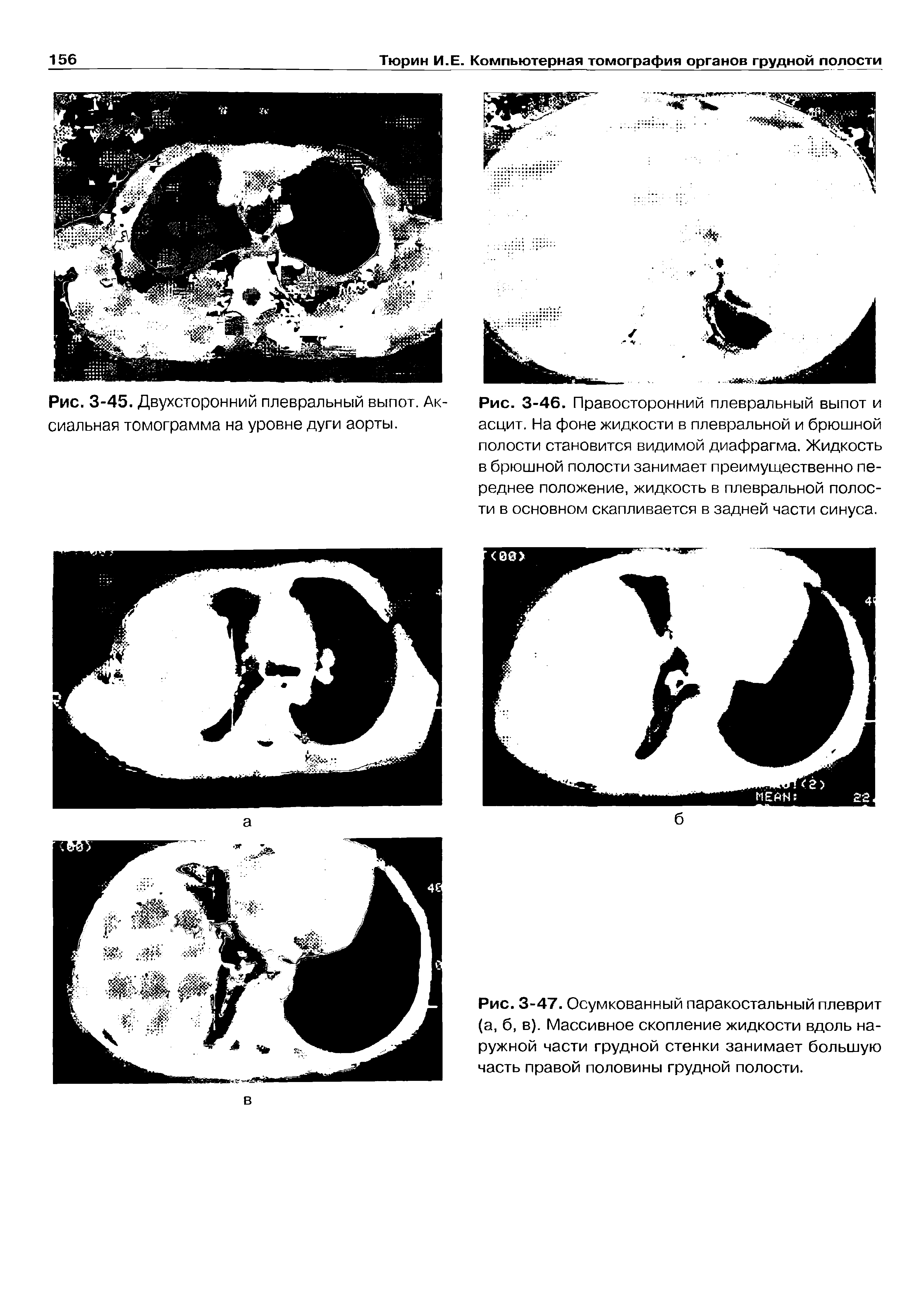 Рис. 3-47. Осумкованный паракостальный плеврит (а, б, в). Массивное скопление жидкости вдоль наружной части грудной стенки занимает большую часть правой половины грудной полости.