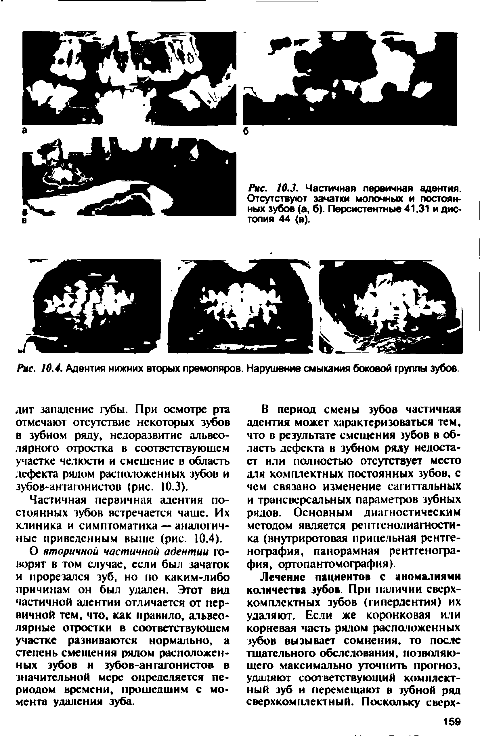 Рис. 10.3. Частичная первичная адентия. Отсутствуют зачатки молочных и постоянных зубов (а, б). Персистентные 41,31 и дистопия 44 (в).