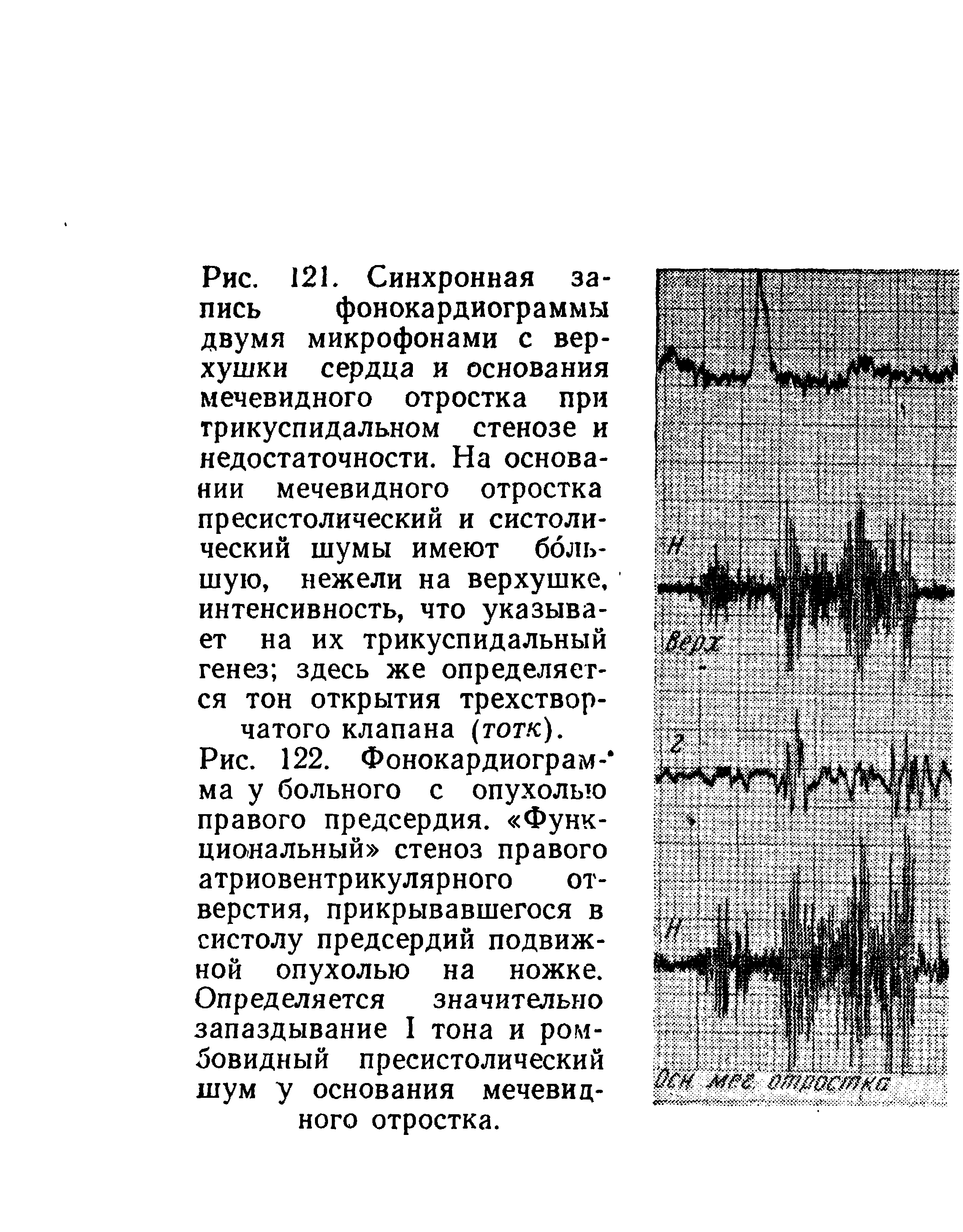 Рис. 122. Фонокардиограм- ма у больного с опухолью правого предсердия. Функциональный стеноз правого атриовентрикулярного отверстия, прикрывавшегося в систолу предсердий подвижной опухолью на ножке. Определяется значительно запаздывание I тона и ромбовидный пресистолический шум у основания мечевидного отростка.