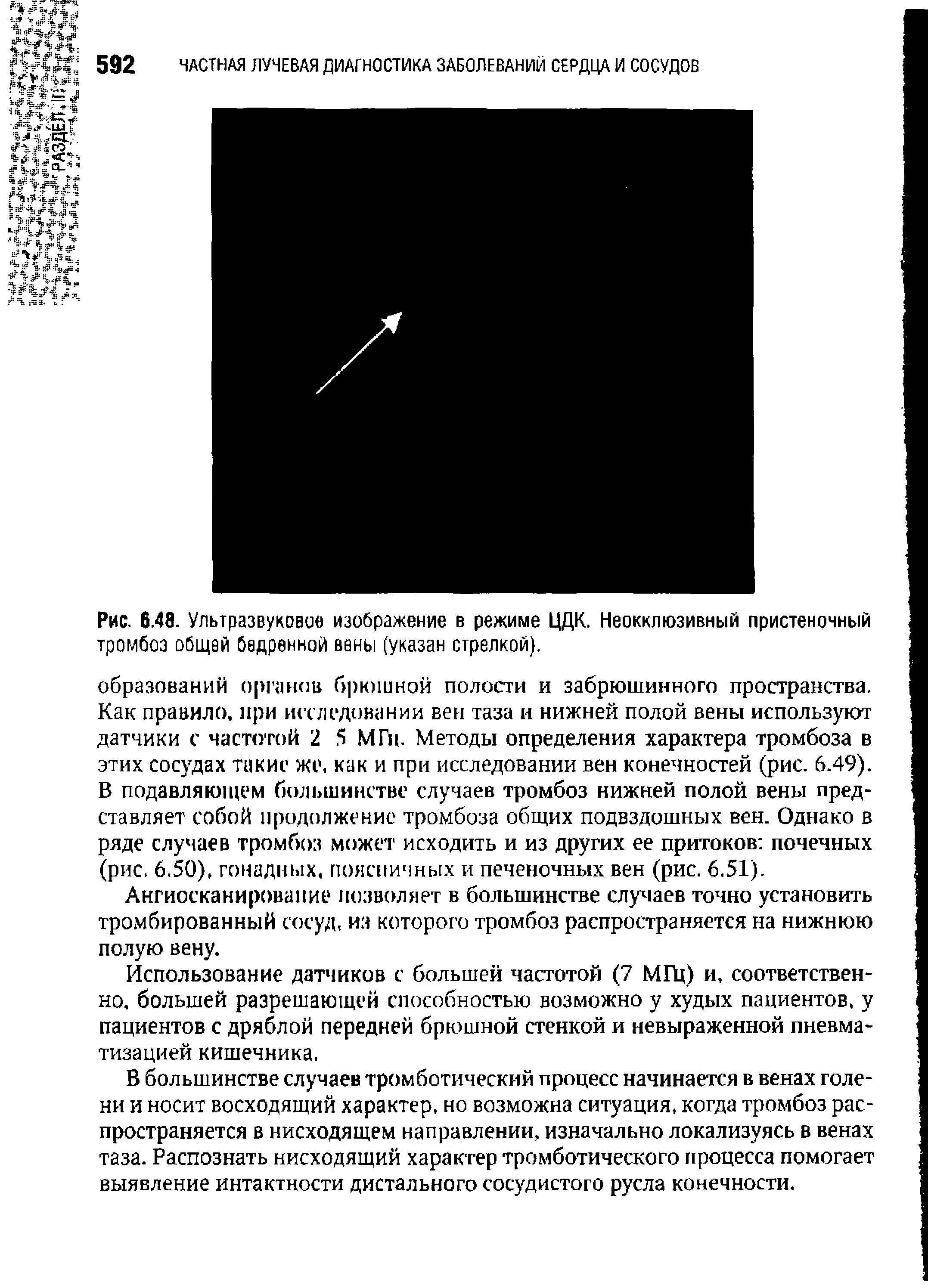 Рис. 6.48. Ультразвуковое изображение в режиме ЦДК. Неокклюзивный пристеночный тромбоз общей бедренной вены (указан стрелкой).