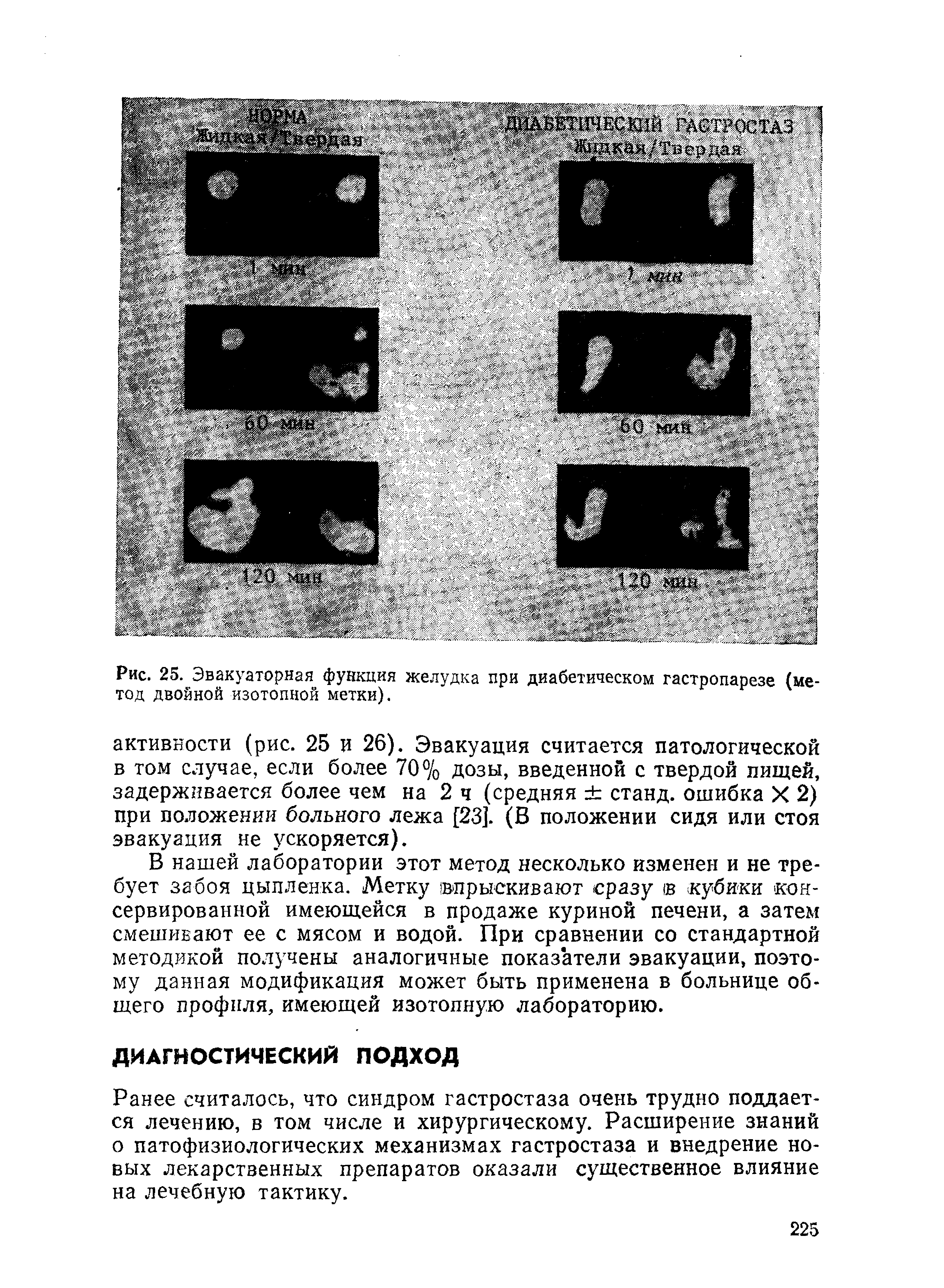 Рис. 25. Эвакуаторная функция желудка при диабетическом гастропарезе (метод двойной изотопной метки).