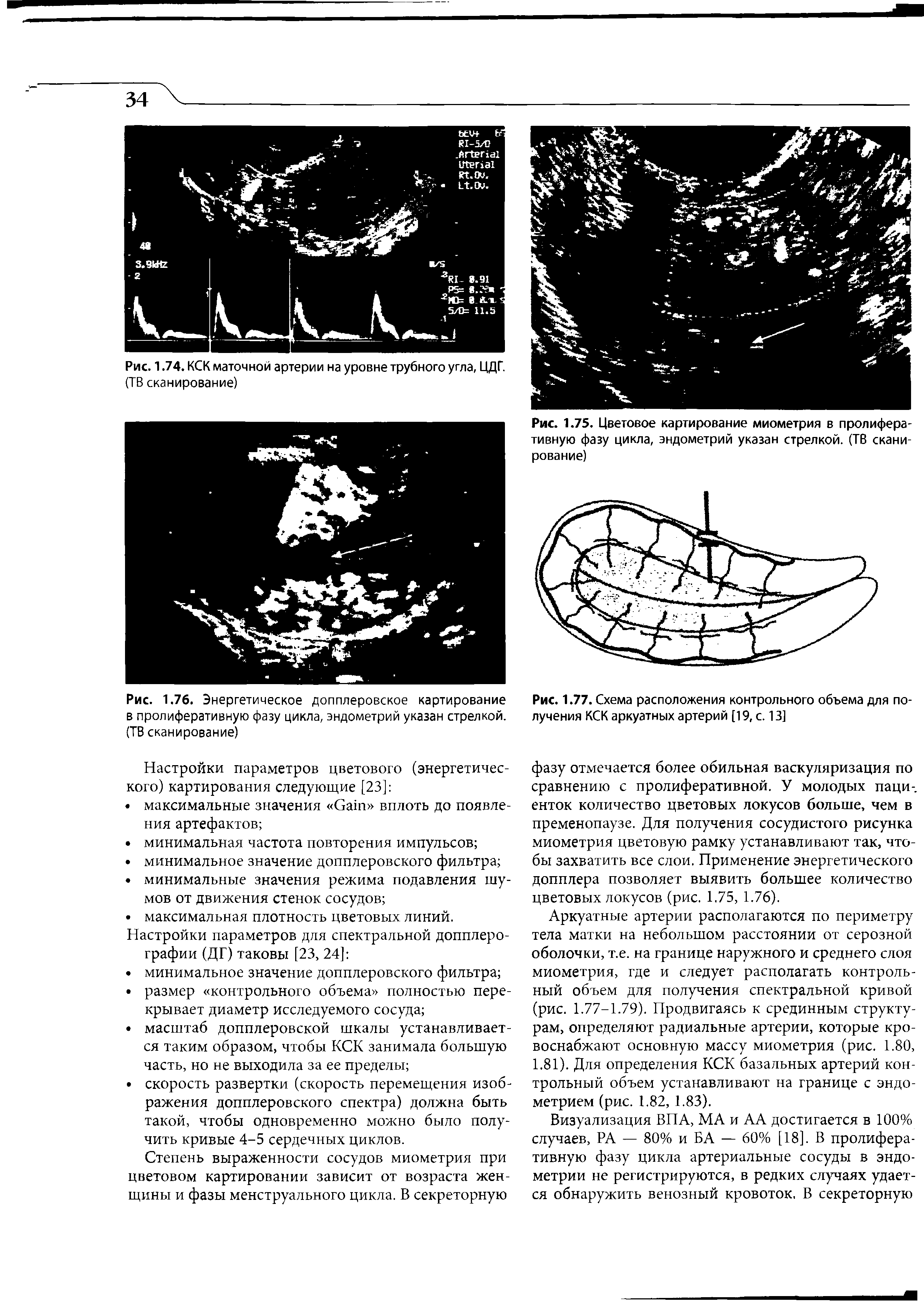 Рис. 1.75. Цветовое картирование миометрия в пролиферативную фазу цикла, эндометрий указан стрелкой. (ТВ сканирование)...