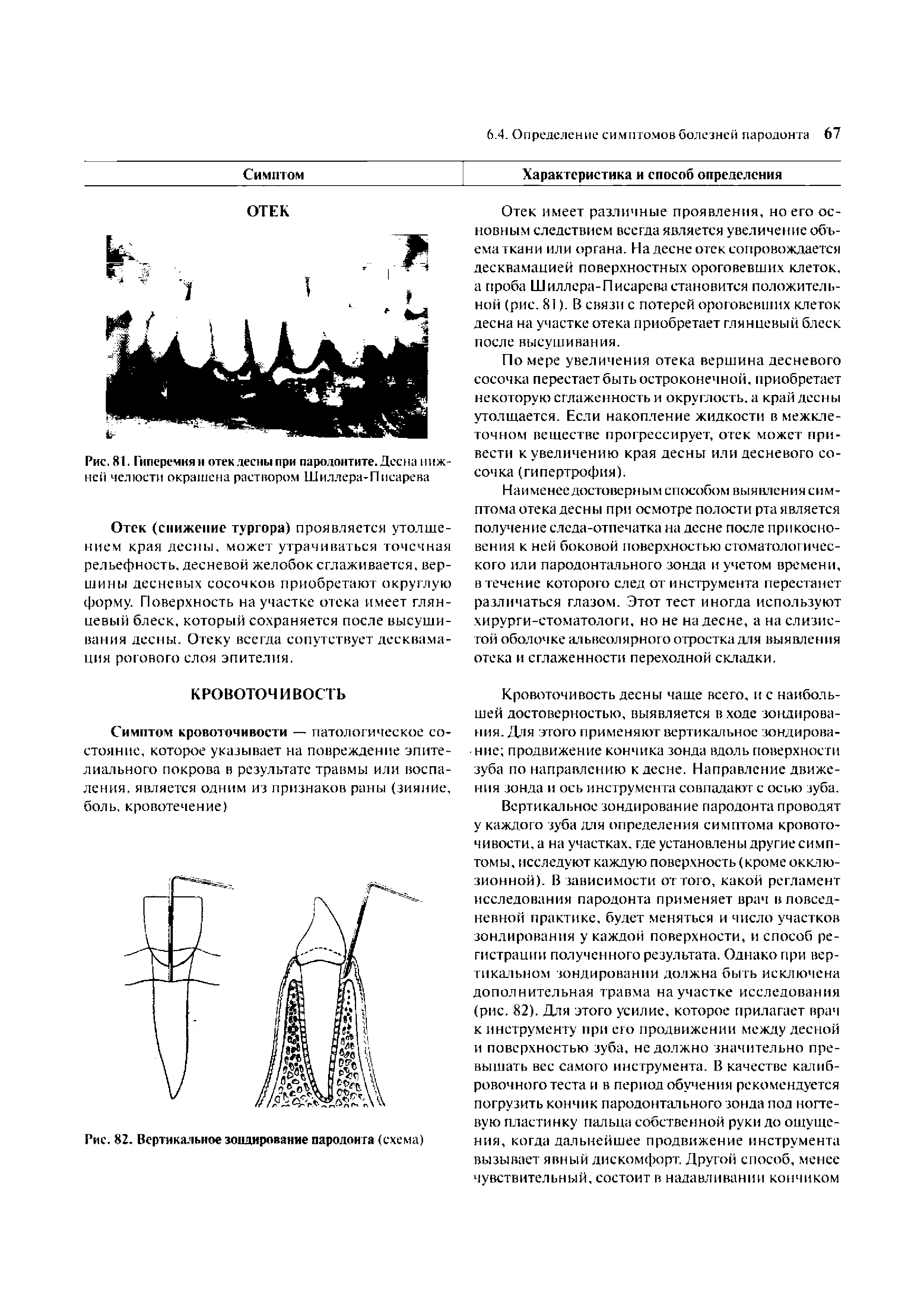 Рис. 81. Гиперемия и отек десны при пародонтите. Десна нижней челюсти окрашена раствором Шиллера-Писарева...