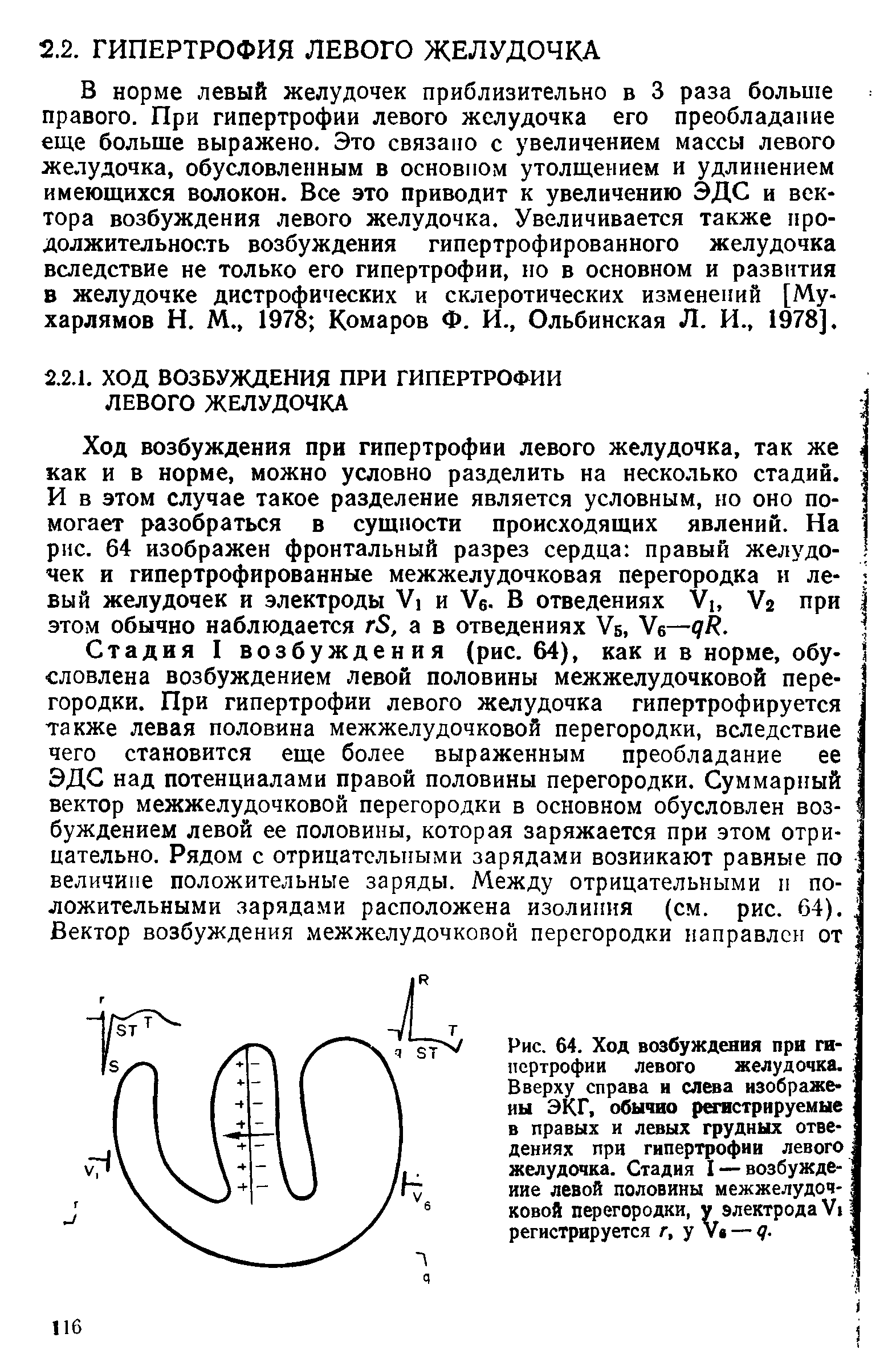 Рис. 64. Ход возбуждения при гипертрофии левого желудочка. Вверху справа и слева изображены ЭКГ, обычно регистрируемые в правых и левых грудных отведениях при гипертрофии левого желудочка. Стадия I — возбуждение левой половины межжелудочковой перегородки, у электрода VI регистрируется г, у V — д.