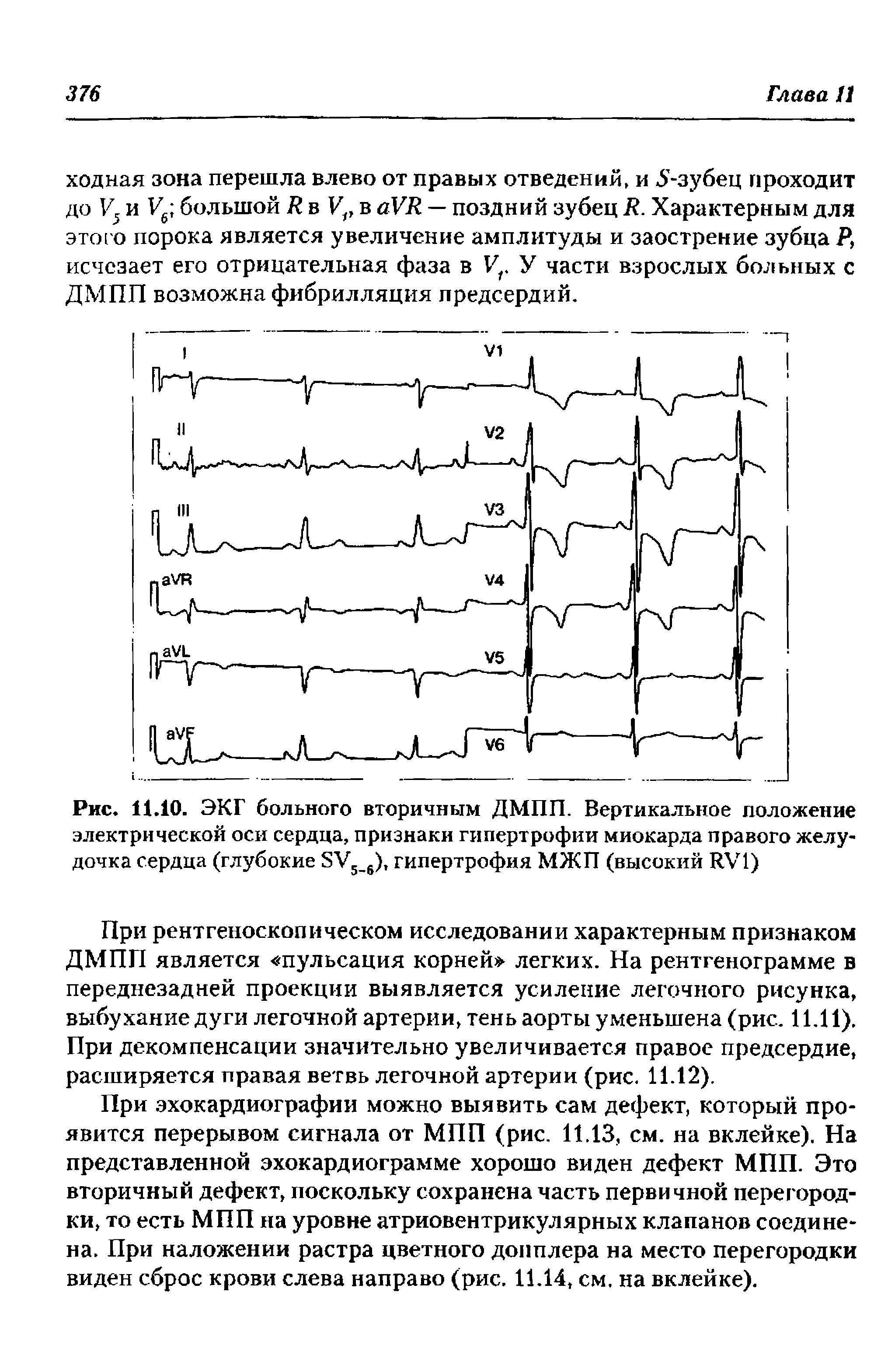 Рис. 11.10. ЭКГ больного вторичным ДМПП. Вертикальное положение электрической оси сердца, признаки гипертрофии миокарда правого желудочка сердца (глубокие ЗУ5 6), гипертрофия МЖП (высокий Ю/1)...