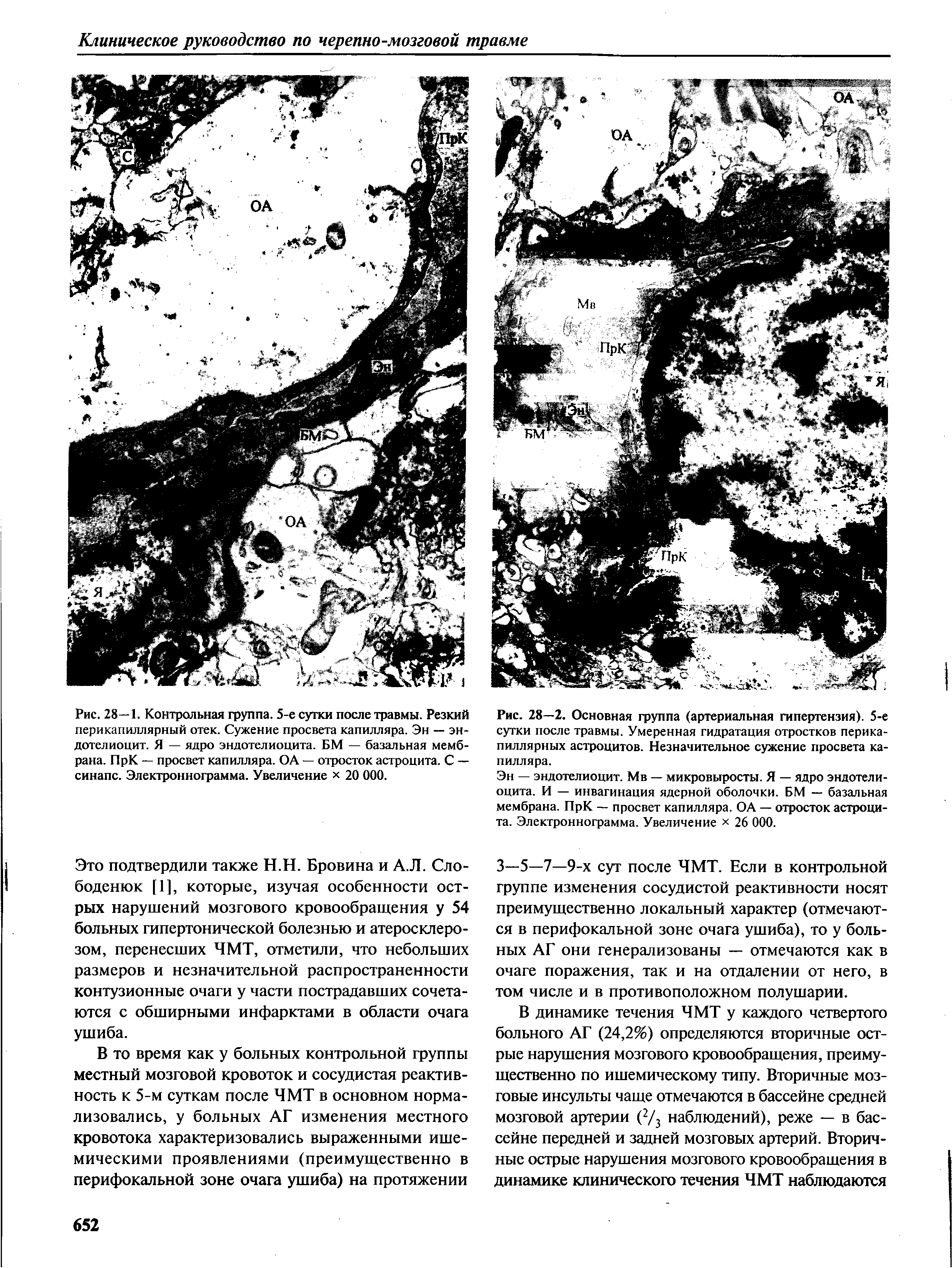 Рис. 28—1. Контрольная группа. 5-е сутки после травмы. Резкий перикапиллярный отек. Сужение просвета капилляра. Эн — эн-дотелиоцит. Я — ядро эндотелиоцита. БМ — базальная мембрана. ПрК — просвет капилляра. ОА — отросток астроцита. С — синапс. Электроннограмма. Увеличение х 20 000.