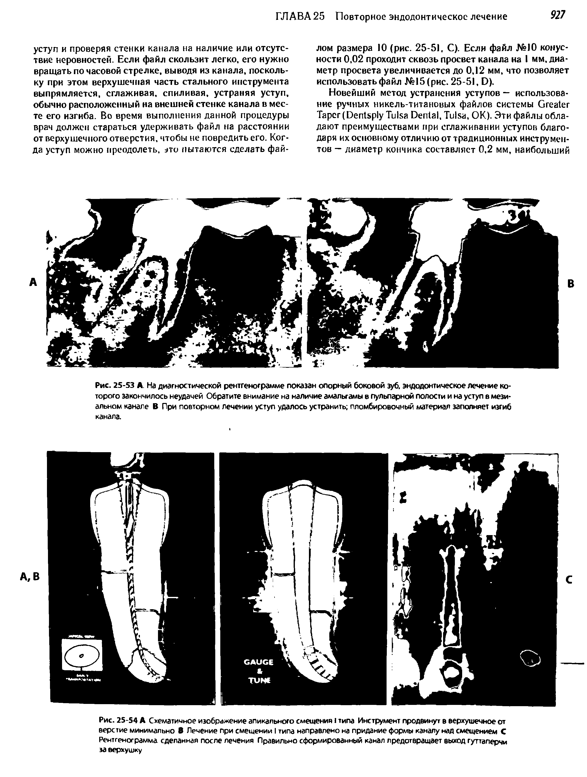 Рис. 25-54 А Схематичное изображение апикального смещения I типа Инструмент продвинут в верхушечное от верстие минимально В Лечение при смещении I типа направлено на придание формы каналу над смещением С Рентгенограмма сделанная после лечения Правильно сформированный канал предотвращает выход гуттаперчи за верхушку...