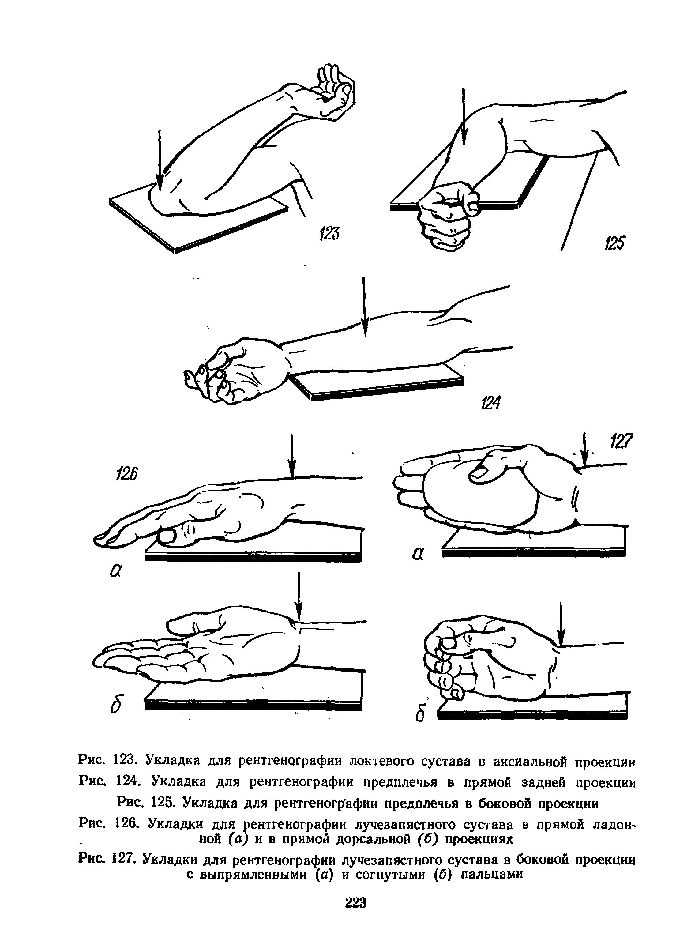 Рис. 126. Укладки для рентгенографии лучезапястного сустава в прямой ладон ной (а) и в прямой дорсальной (б) проекциях...