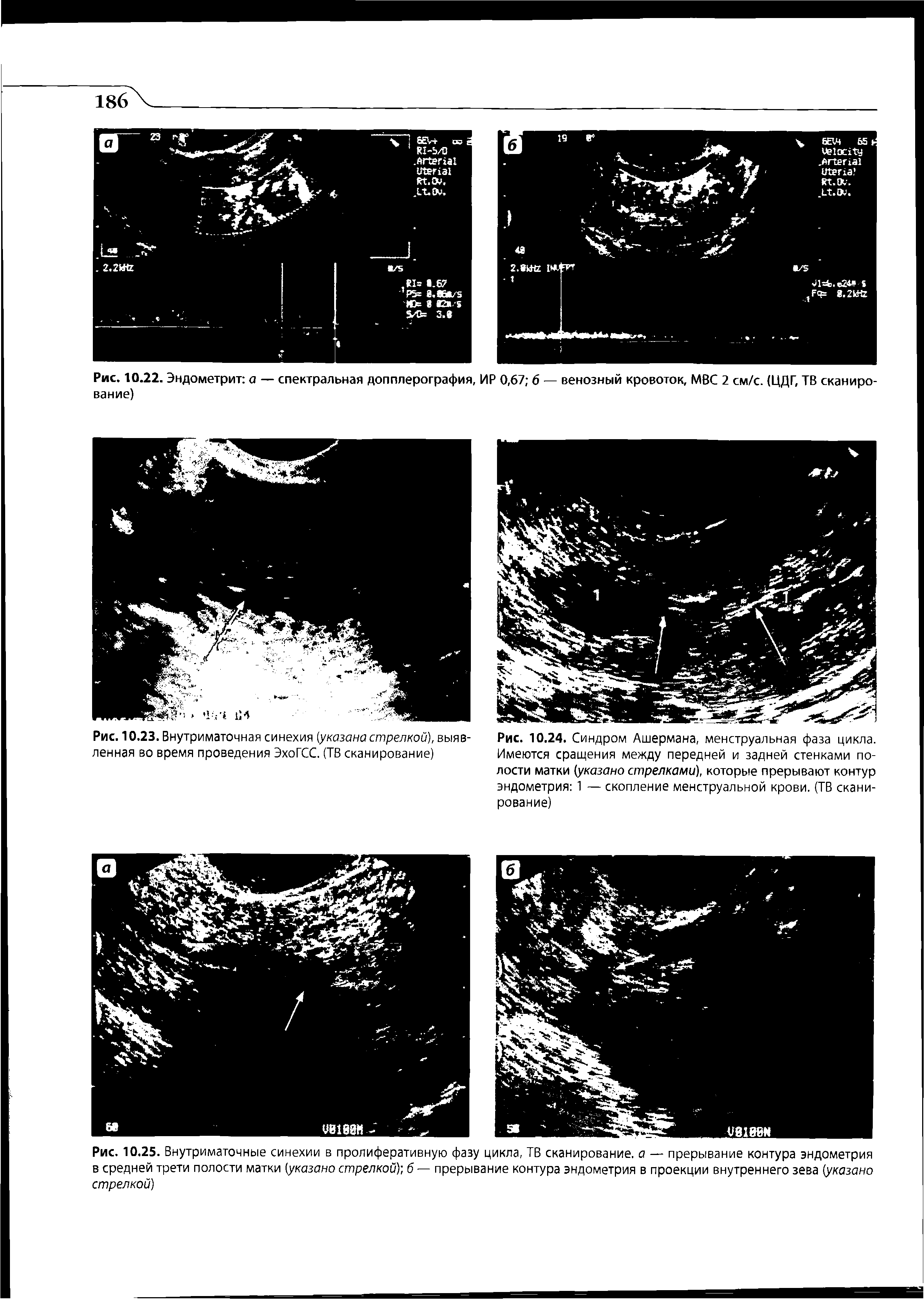 Рис. 10.24. Синдром Ашермана, менструальная фаза цикла. Имеются сращения между передней и задней стенками полости матки (указано стрелками), которые прерывают контур эндометрия 1 — скопление менструальной крови. (ТВ сканирование)...