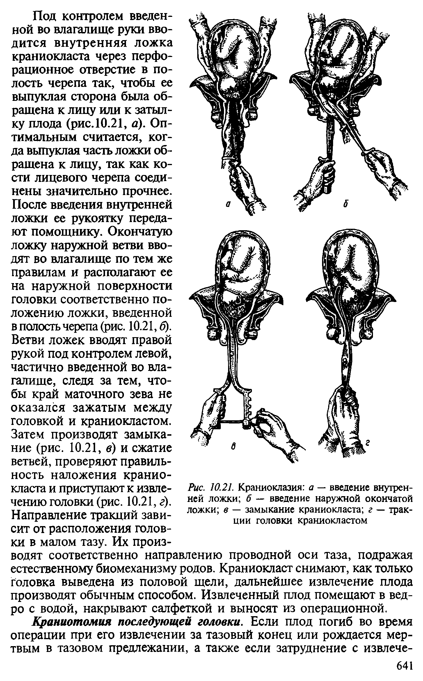 Рис. 10.21. Краниоклазия а — введение внутренней ложки б — введение наружной окончатой ложки в — замыкание краниокласта г — тракции головки краниокластом...