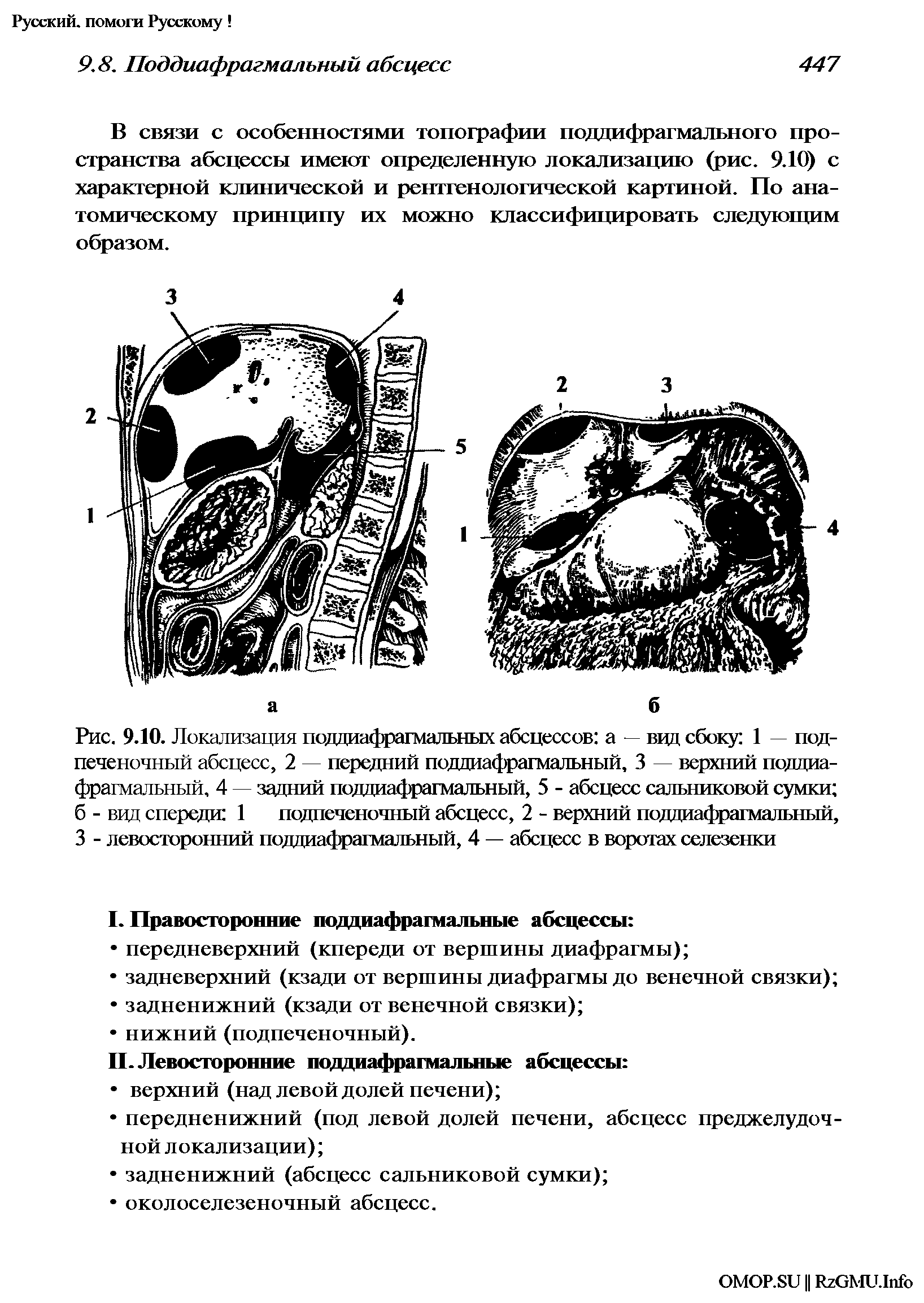 Рис. 9.10. Локализация поддиафрагмальных абсцессов а — вцд сбоку 1 — подпеченочный абсцесс, 2 — передний поддиафрагмальный, 3 — верхний поддиафрагмальный, 4 — задний поддиафрагмальный, 5 - абсцесс сальниковой сумки б - вид спереди 1 подпеченочный абсцесс, 2 - верхний поддиафрагмальный, 3 - левосторонний поддиафрагмальный, 4 — абсцесс в воротах селезенки...