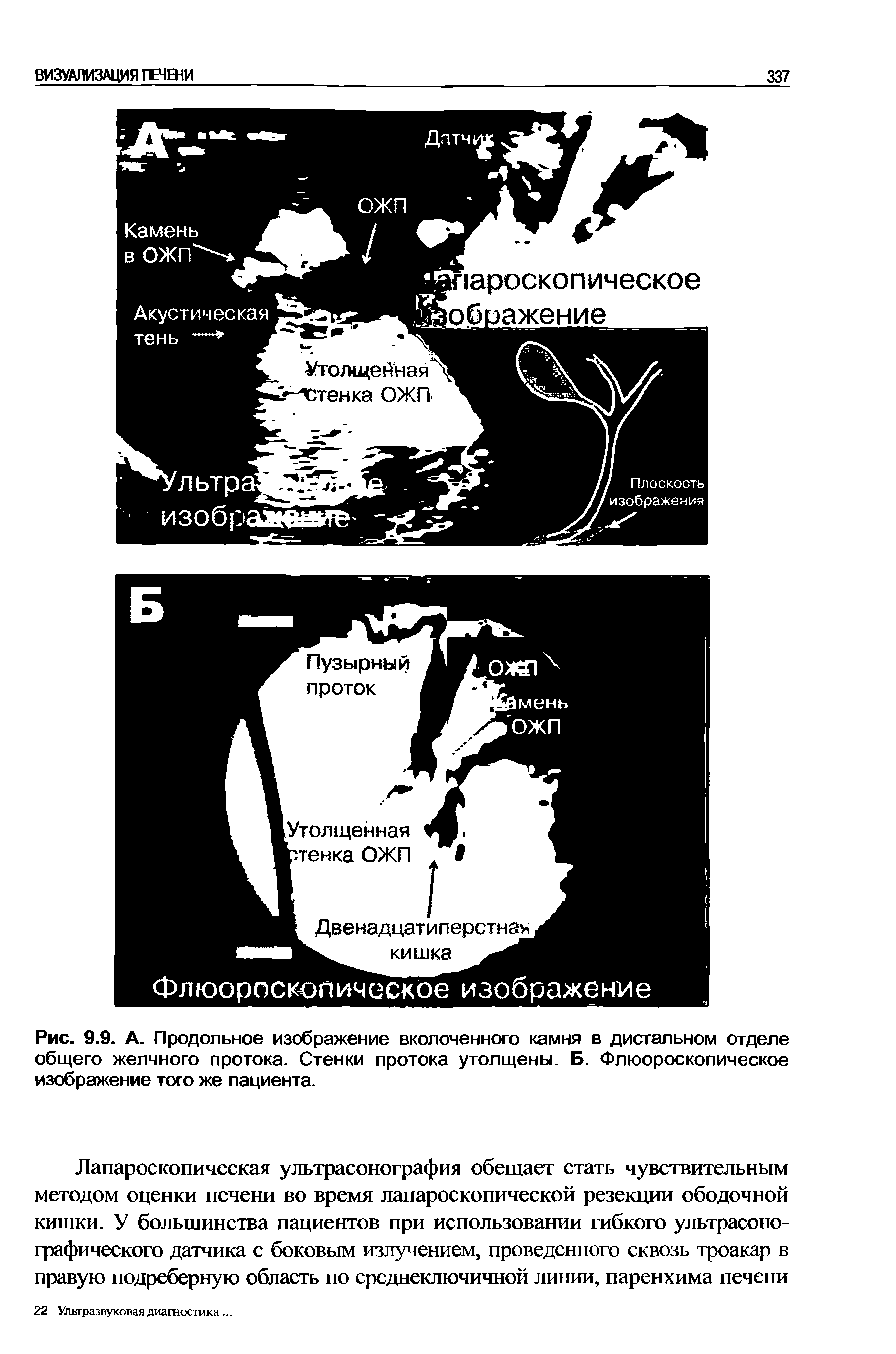 Рис. 9.9. А. Продольное изображение вколоченного камня в дистальном отделе общего желчного протока. Стенки протока утолщены. Б. Флюороскопическое изображение того же пациента.