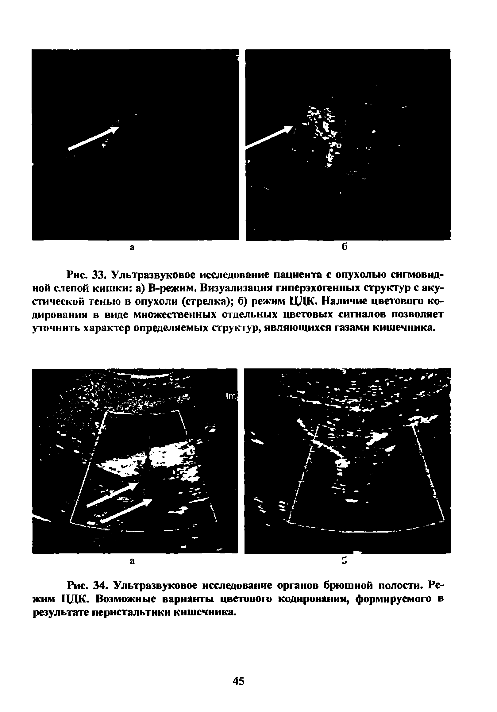 Рис. 34. Ультразвуковое исследование органов брюшной полости. Режим ЦДК. Возможные варианты цветового кодирования, формируемого в результате перистальтики кишечника.