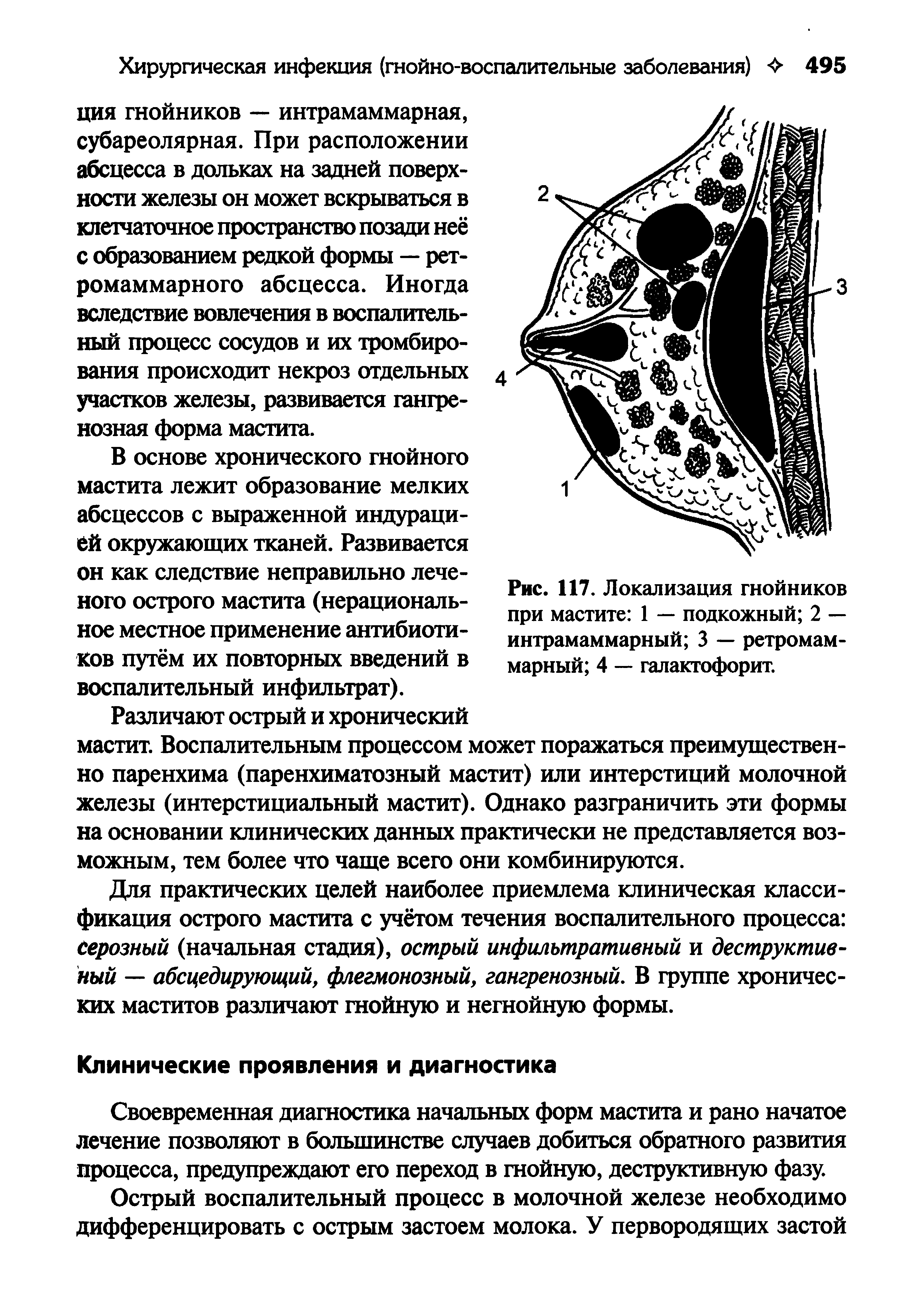 Рис. 117. Локализация гнойников при мастите 1 — подкожный 2 — интрамаммарный 3 — ретромам-марный 4 — галактофорит.