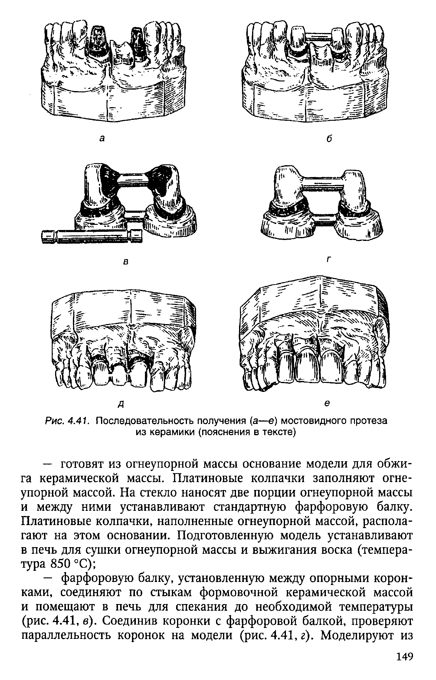 Рис. 4.41. Последовательность получения (а—е) мостовидного протеза из керамики (пояснения в тексте)...