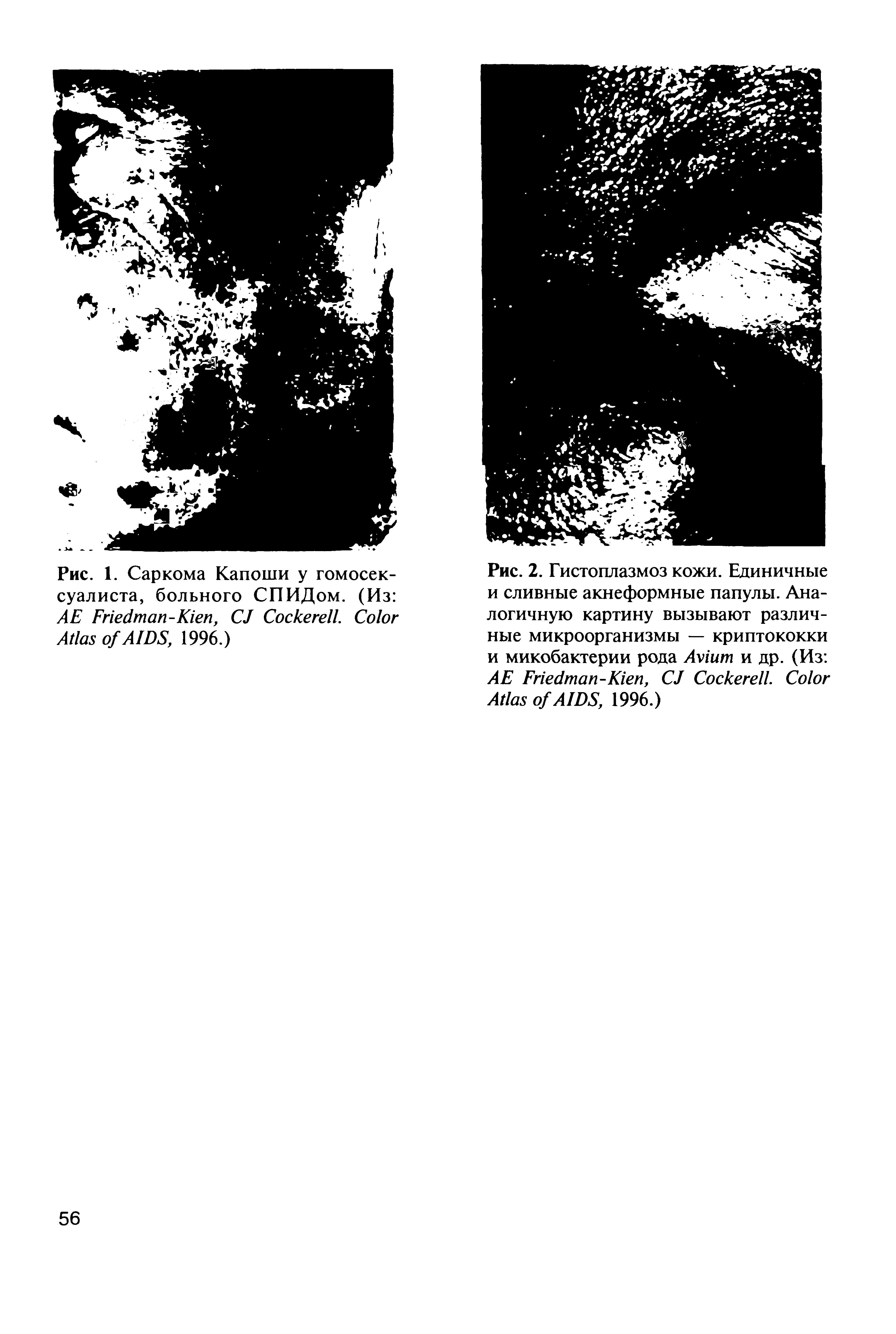 Рис. 2. Гистоплазмоз кожи. Единичные и сливные акнеформные папулы. Аналогичную картину вызывают различные микроорганизмы — криптококки и микобактерии рода A и др. (Из АЕ F -K , CJ C . C A AIDS, 1996.)...