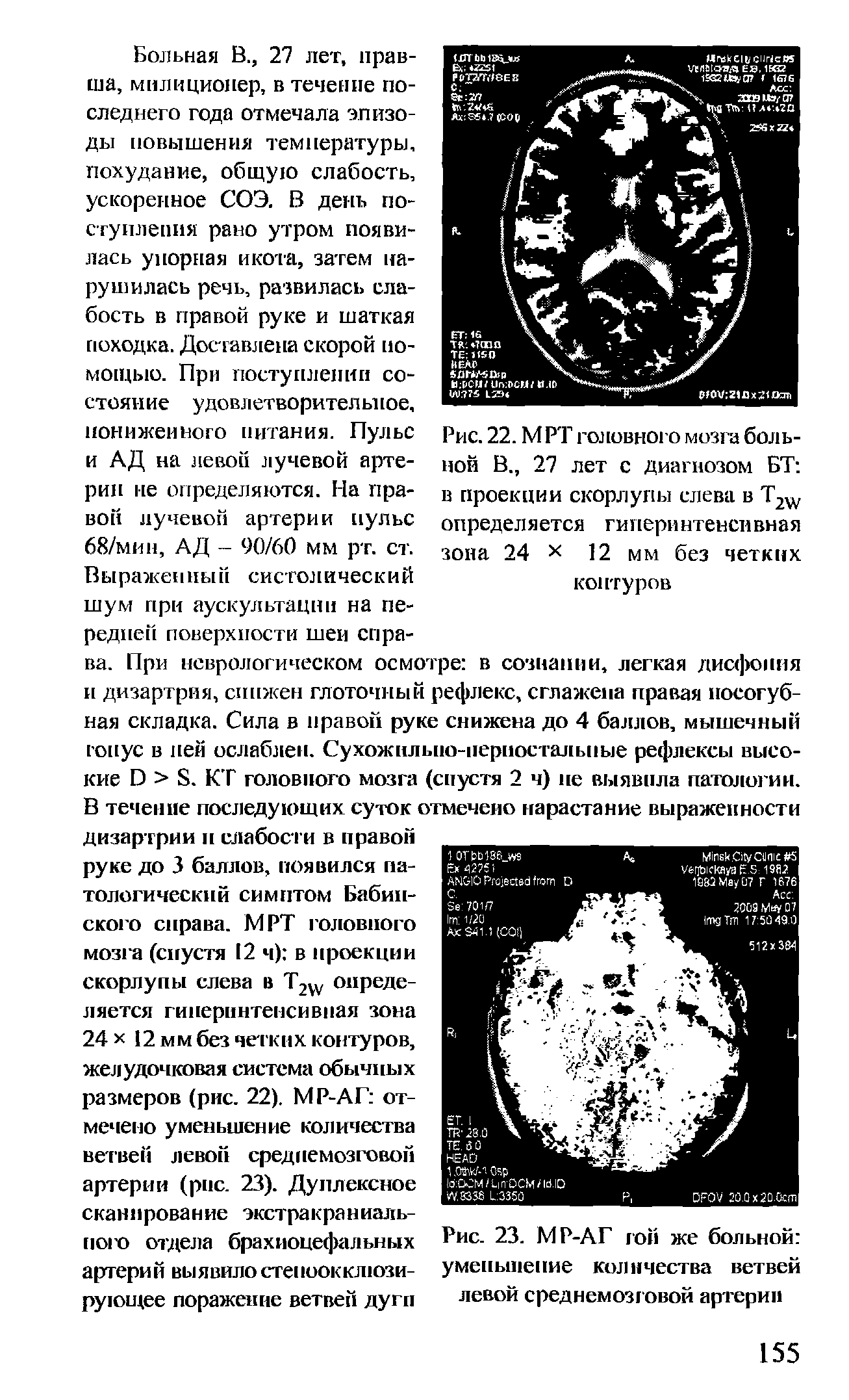 Рис. 22. МРТ головного мозга больной В., 27 лет с диагнозом БТ в проекции скорлупы слева в T2W определяется гиперинтенсивная зона 24 х 12 мм без четких контуров...