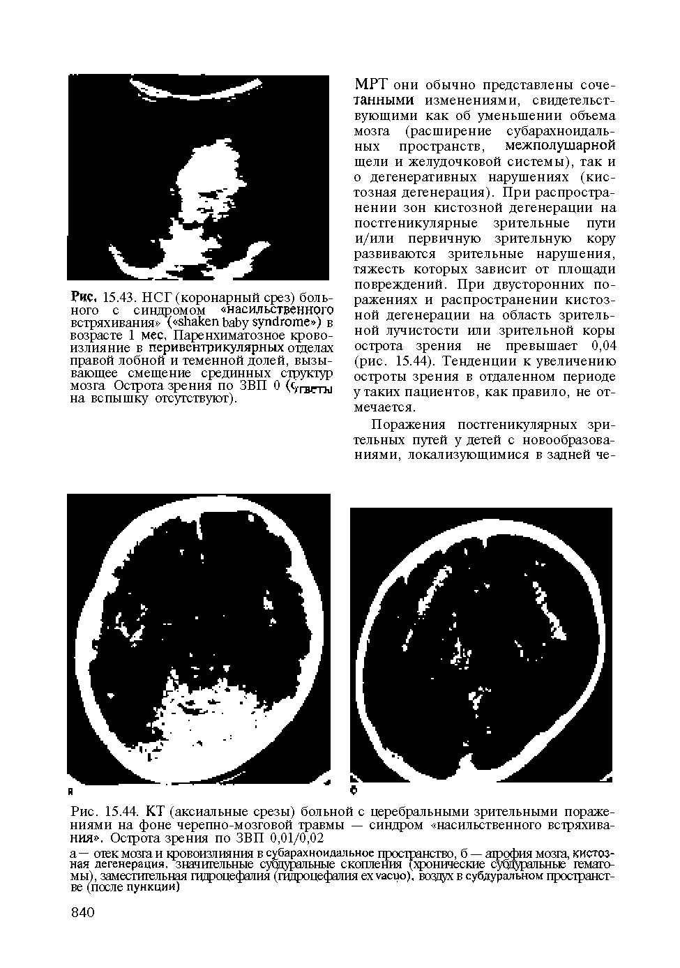 Рис. 15.44. КТ (аксиальные срезы) больной с церебральными зрительными поражениями на фоне черепно-мозговой травмы — синдром насильственного встряхивания . Острога зрения по ЗВП 0,01/0,02...